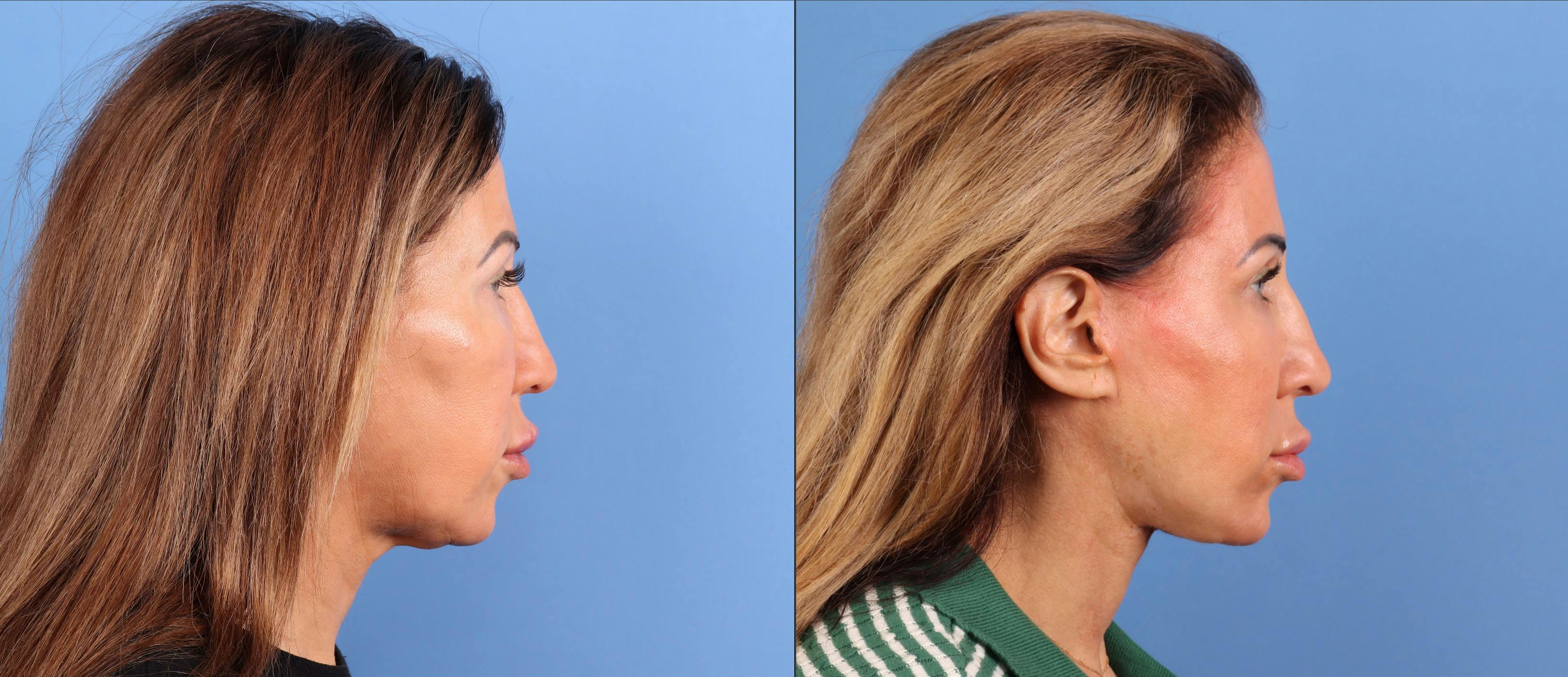 Neck Lift Before & After Gallery - Patient 528893 - Image 5
