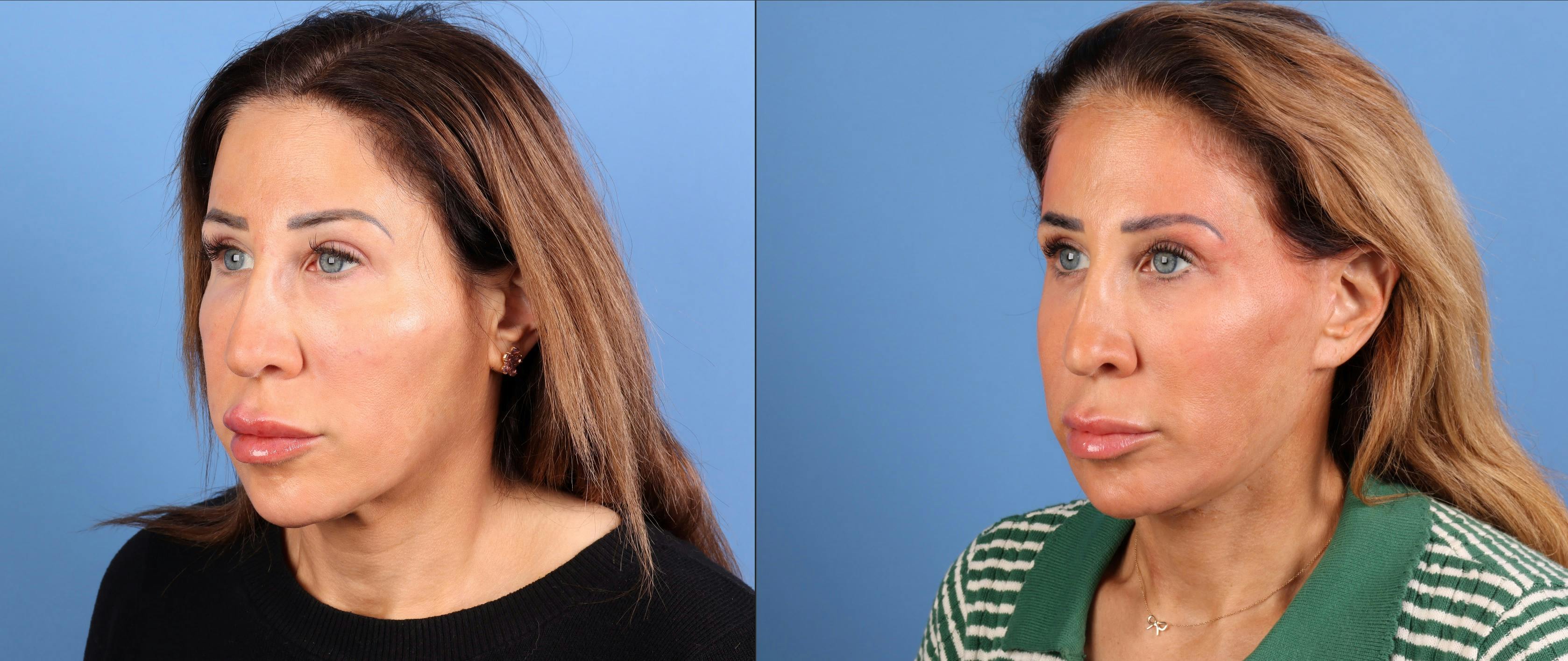 Neck Lift Before & After Gallery - Patient 528893 - Image 4