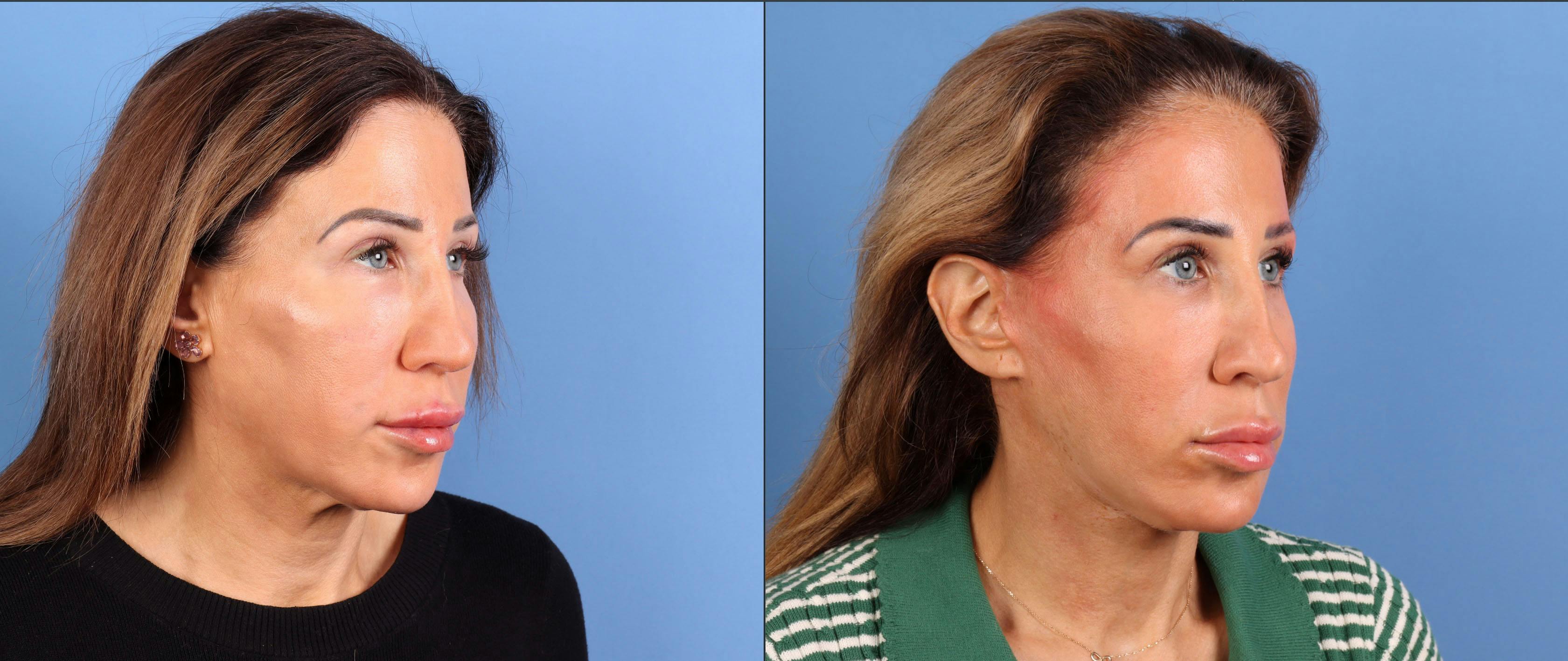 Neck Lift Before & After Gallery - Patient 528893 - Image 3