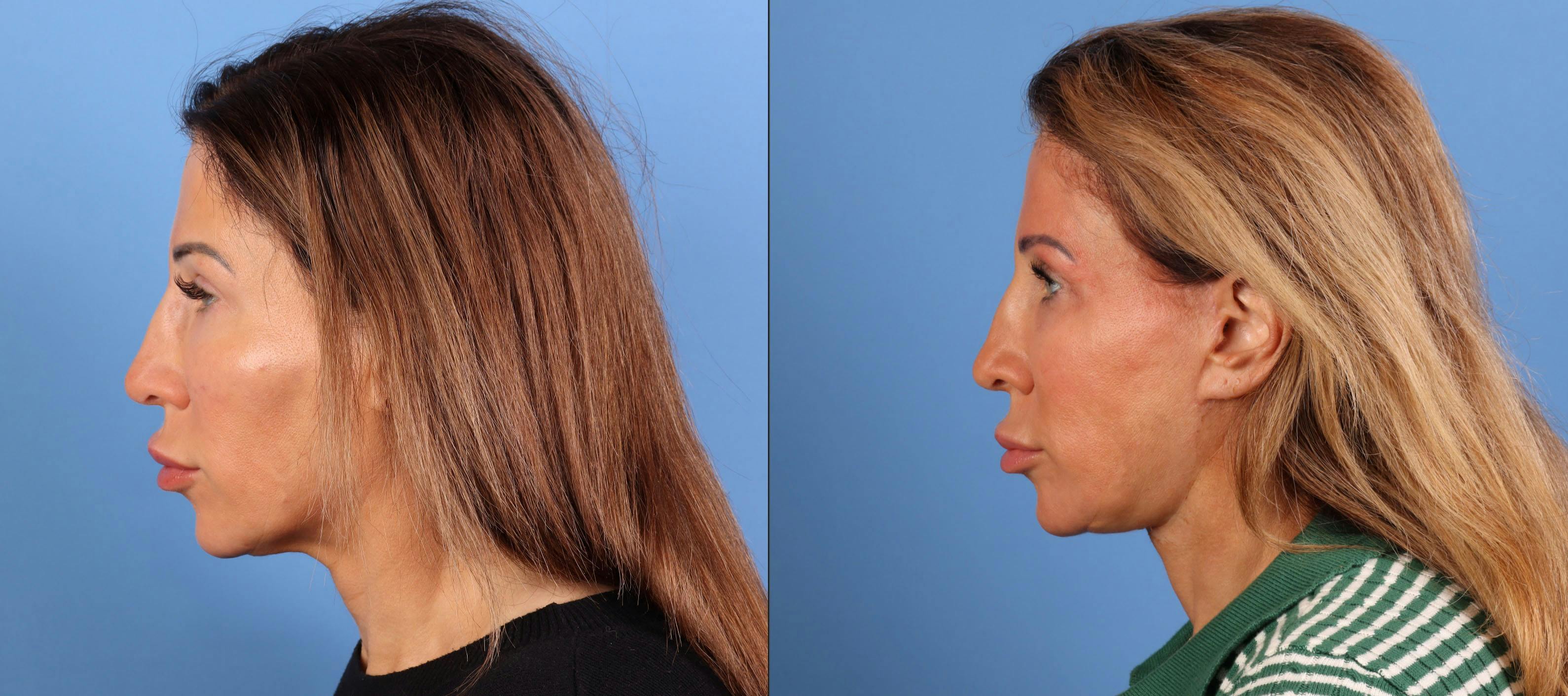 Neck Lift Before & After Gallery - Patient 528893 - Image 1