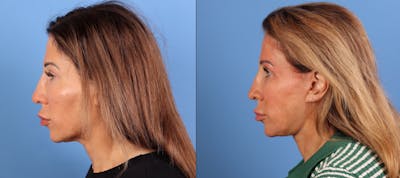 Neck Lift Before & After Gallery - Patient 528893 - Image 1