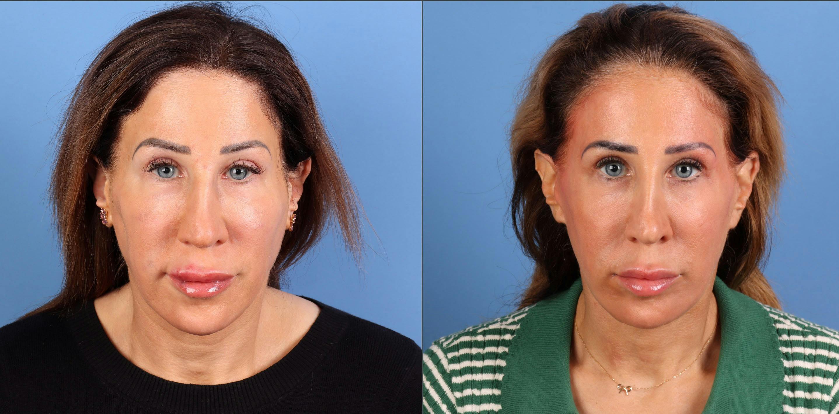 Neck Lift Before & After Gallery - Patient 528893 - Image 2