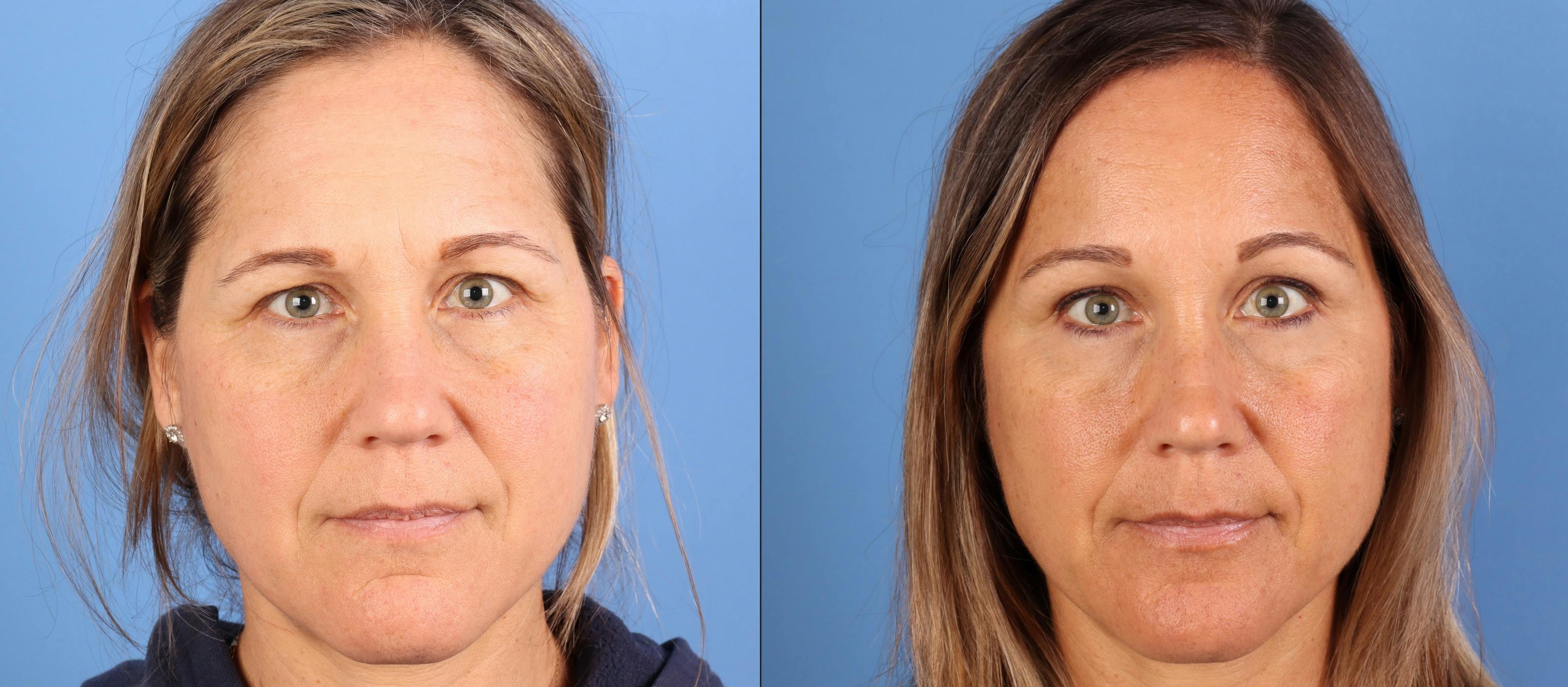 Brow Lift Before & After Gallery - Patient 339579 - Image 1