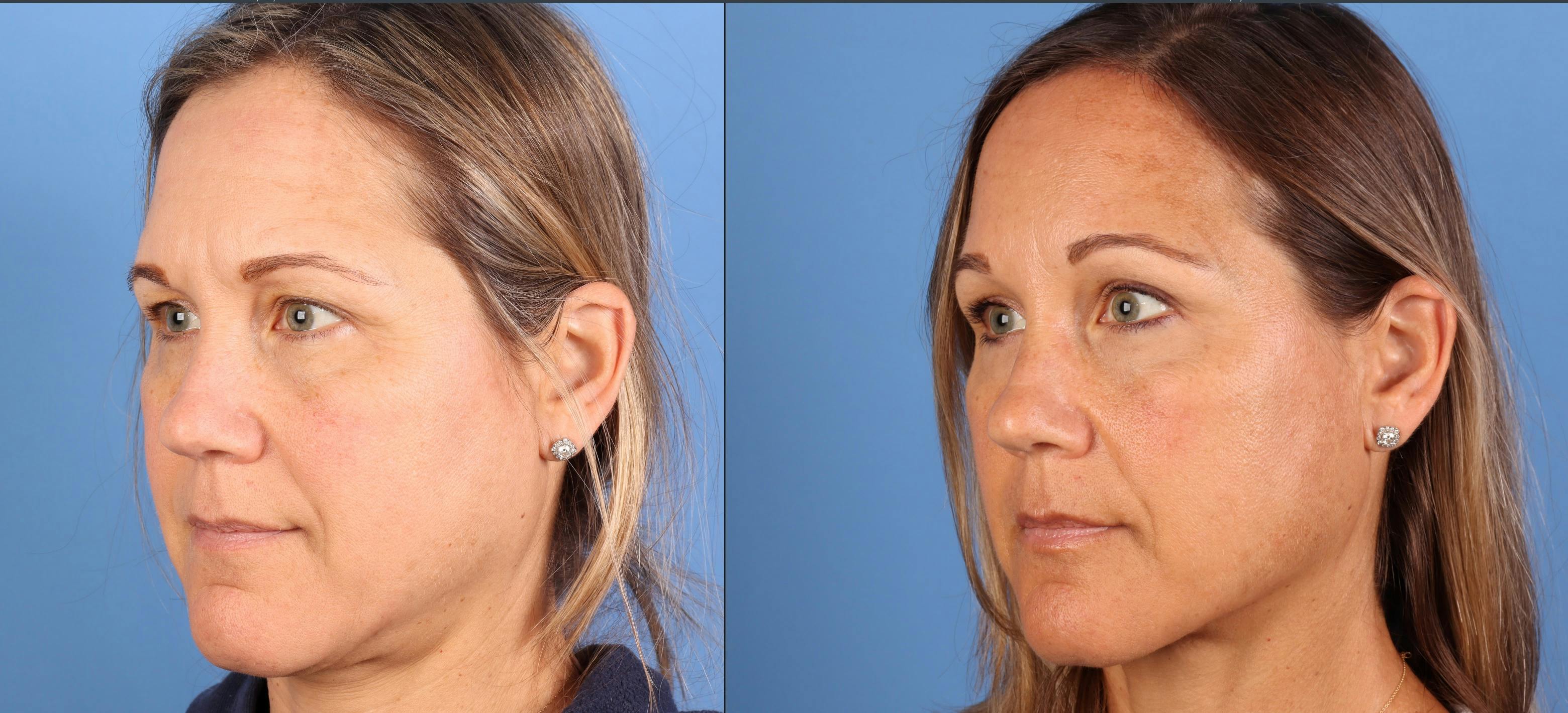 Brow Lift Before & After Gallery - Patient 339579 - Image 4