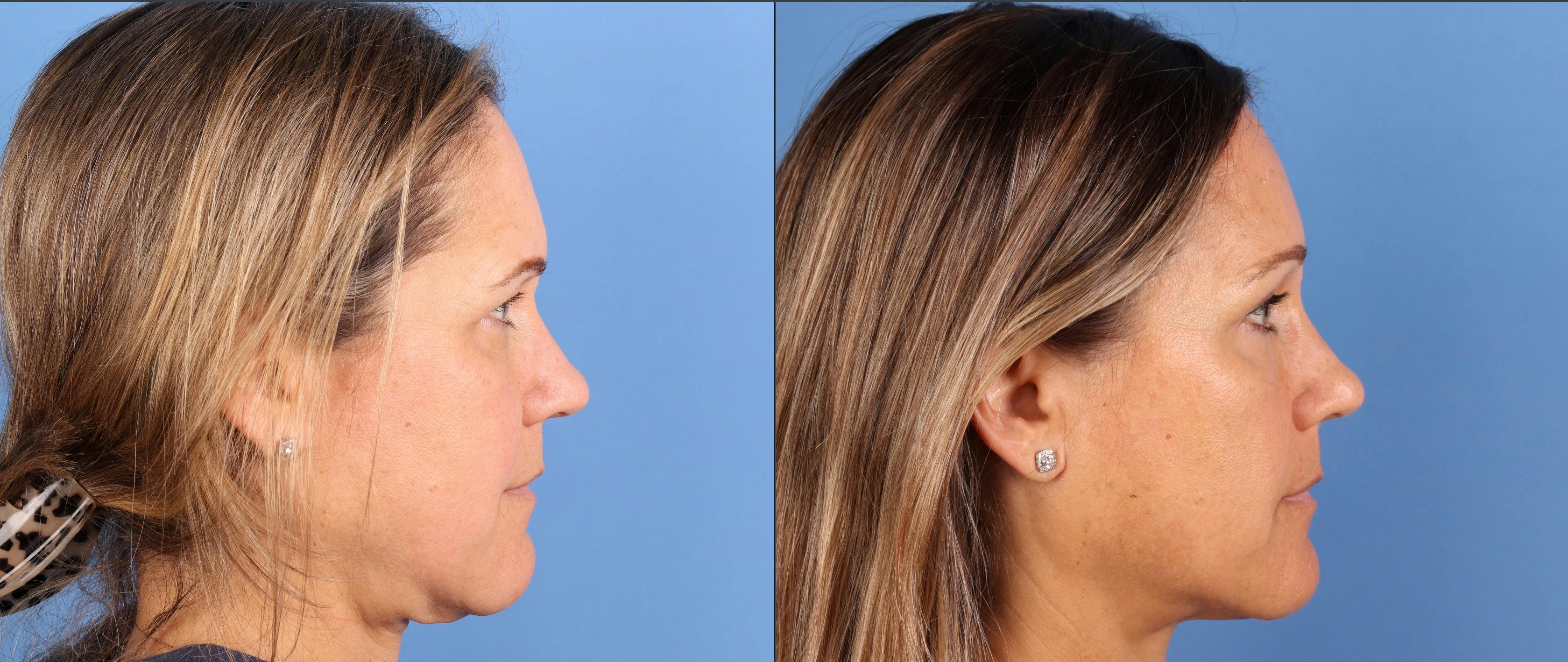 Brow Lift Before & After Gallery - Patient 339579 - Image 3