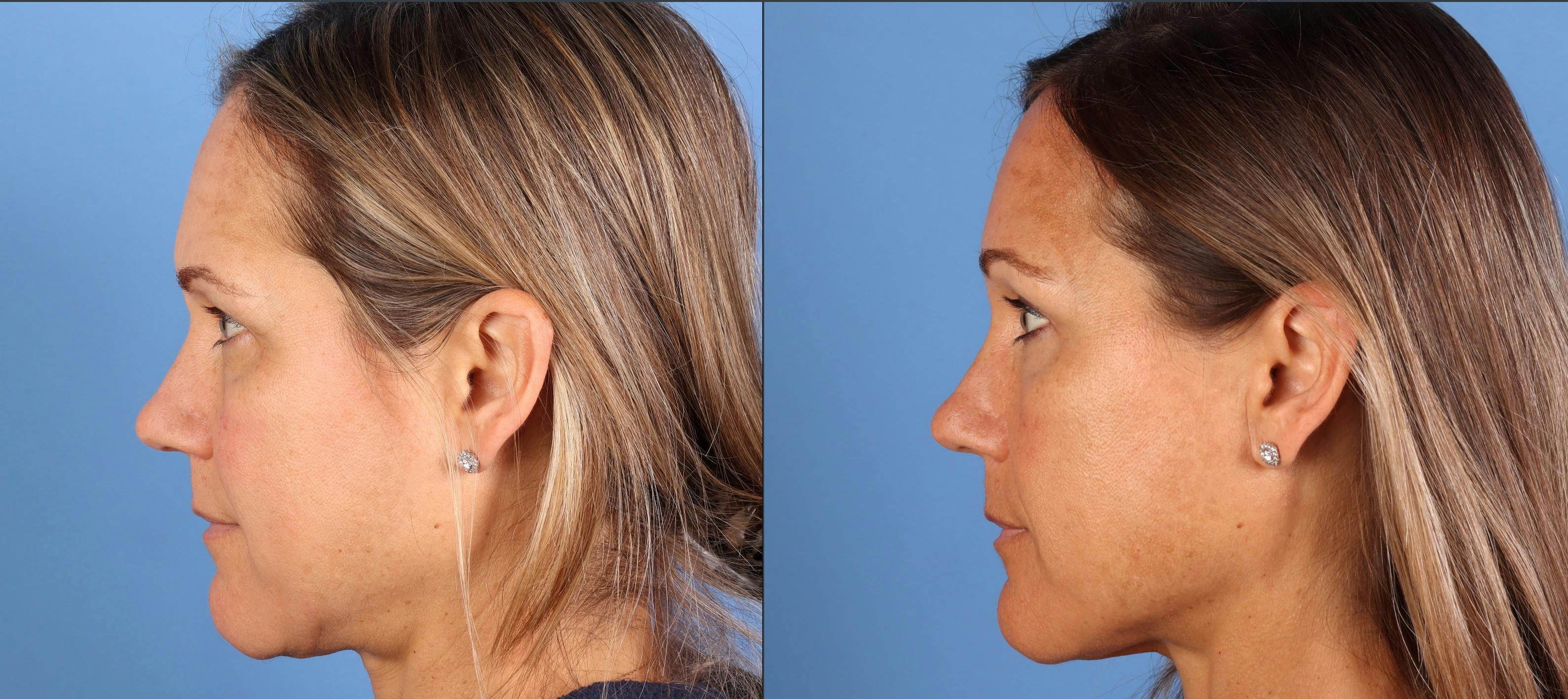 Brow Lift Before & After Gallery - Patient 339579 - Image 5