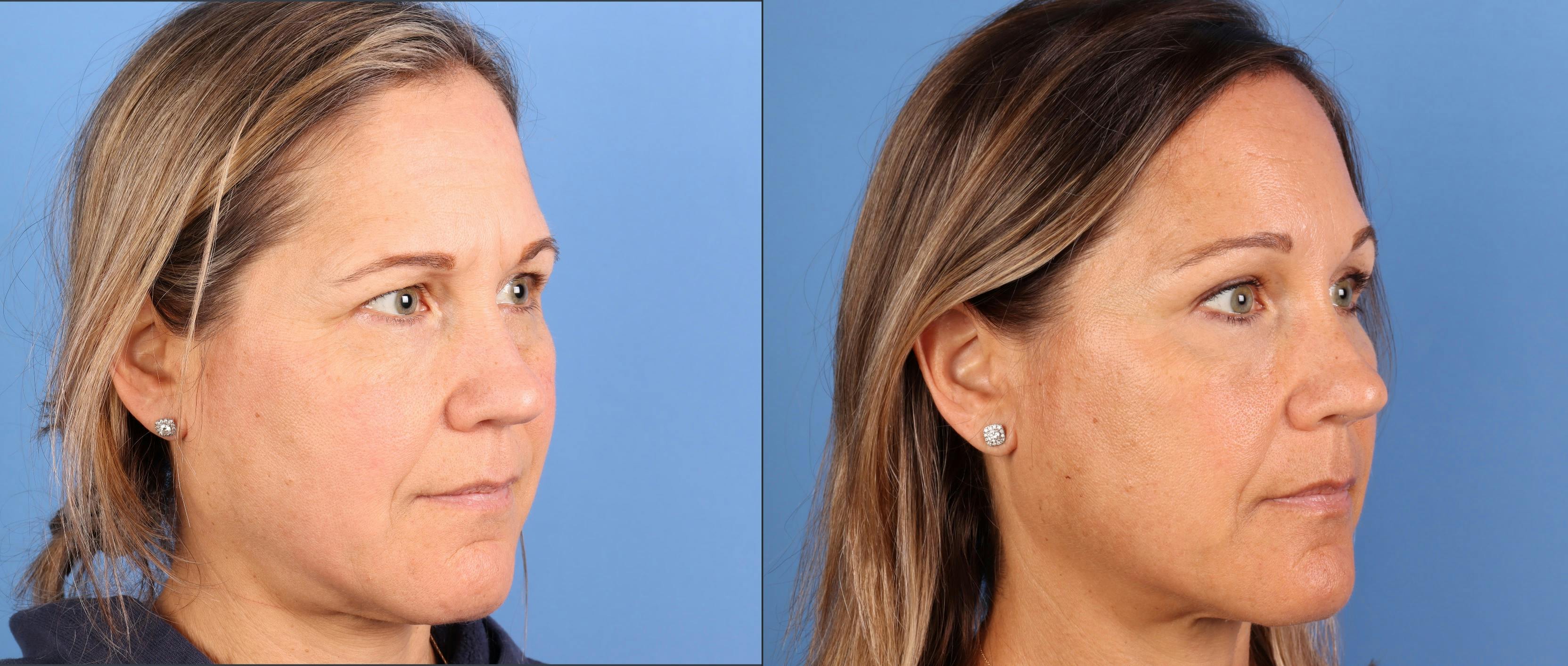 Brow Lift Before & After Gallery - Patient 339579 - Image 2