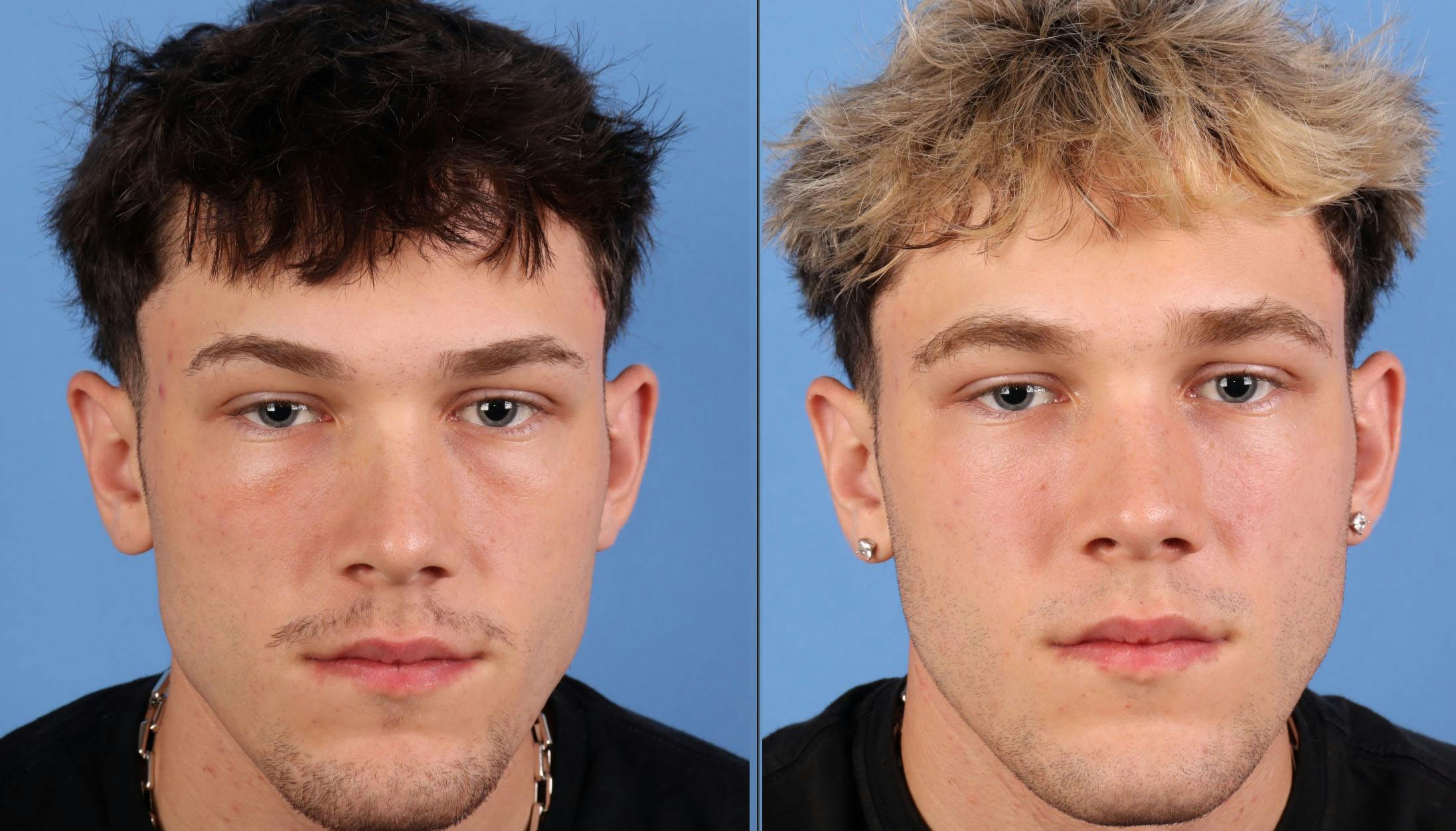 PRF EZ Gel Before & After Gallery - Patient 383233 - Image 1