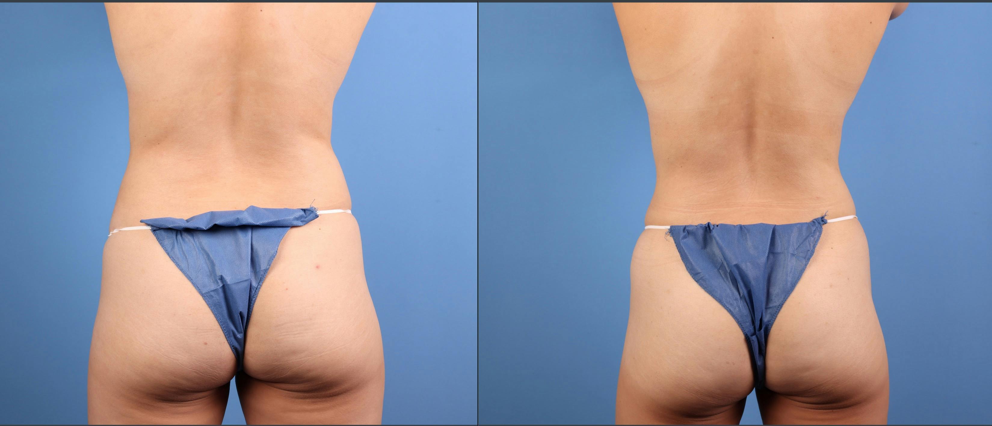 Abdomen Before & After Gallery - Patient 140942 - Image 2
