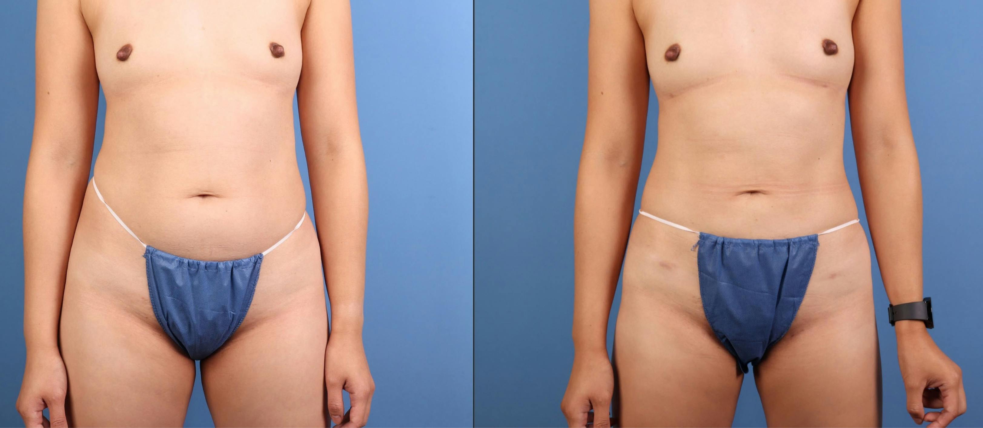 Abdomen Before & After Gallery - Patient 140942 - Image 1