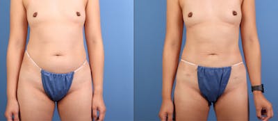 Abdomen Before & After Gallery - Patient 140942 - Image 1