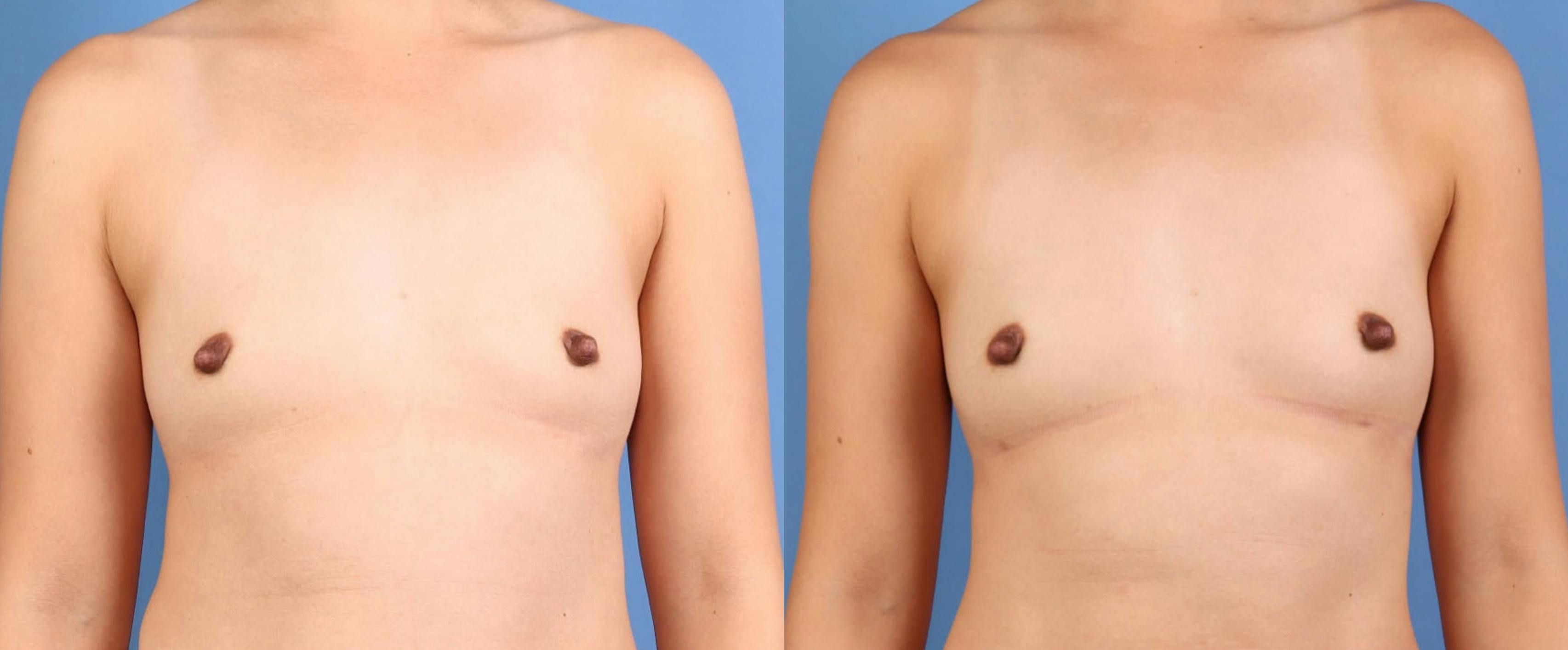 Fat Transfer Breast Augmentation Before & After Gallery - Patient 195010 - Image 1