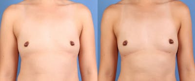 Fat Transfer Breast Augmentation Before & After Gallery - Patient 195010 - Image 1