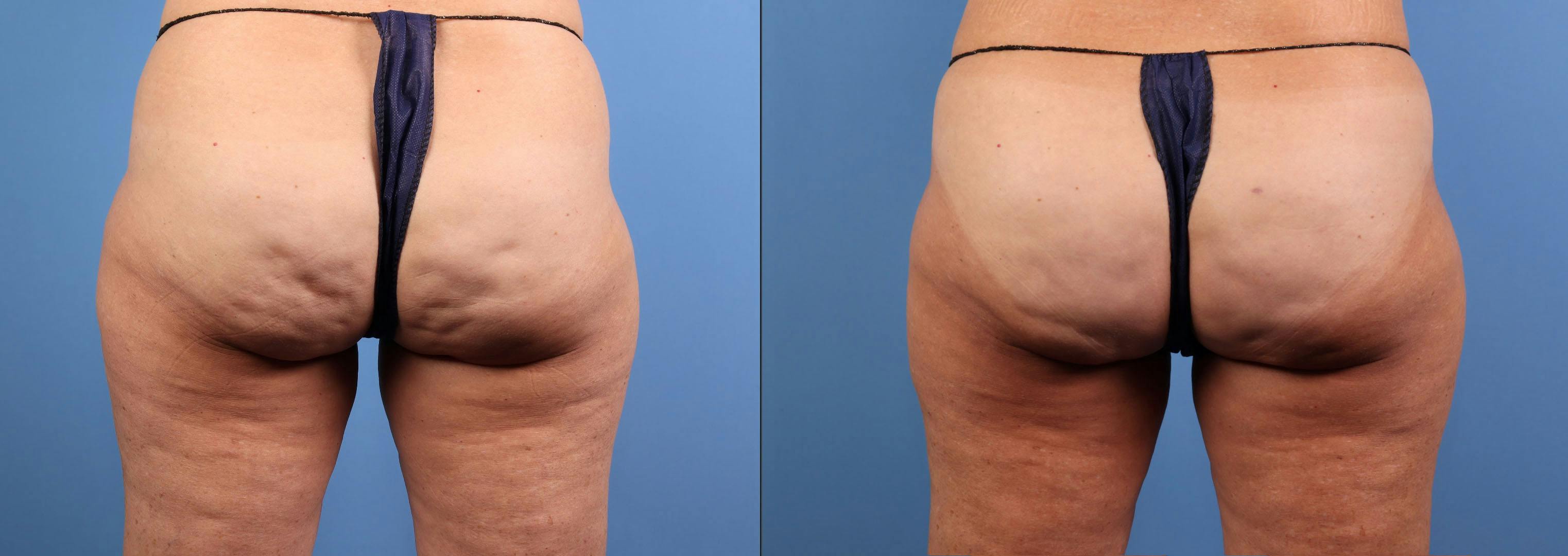 Aveli Before & After Gallery - Patient 150063 - Image 1