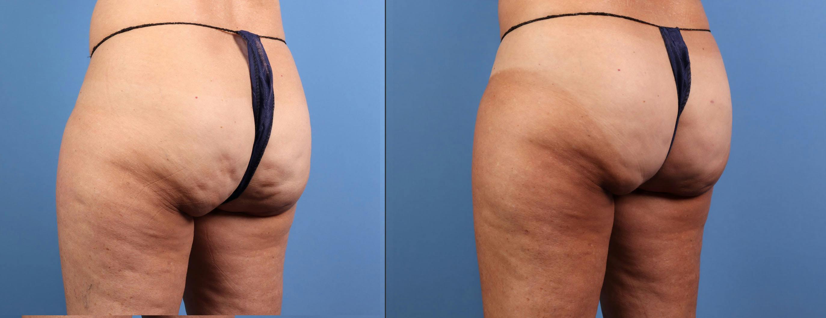Aveli Before & After Gallery - Patient 150063 - Image 2