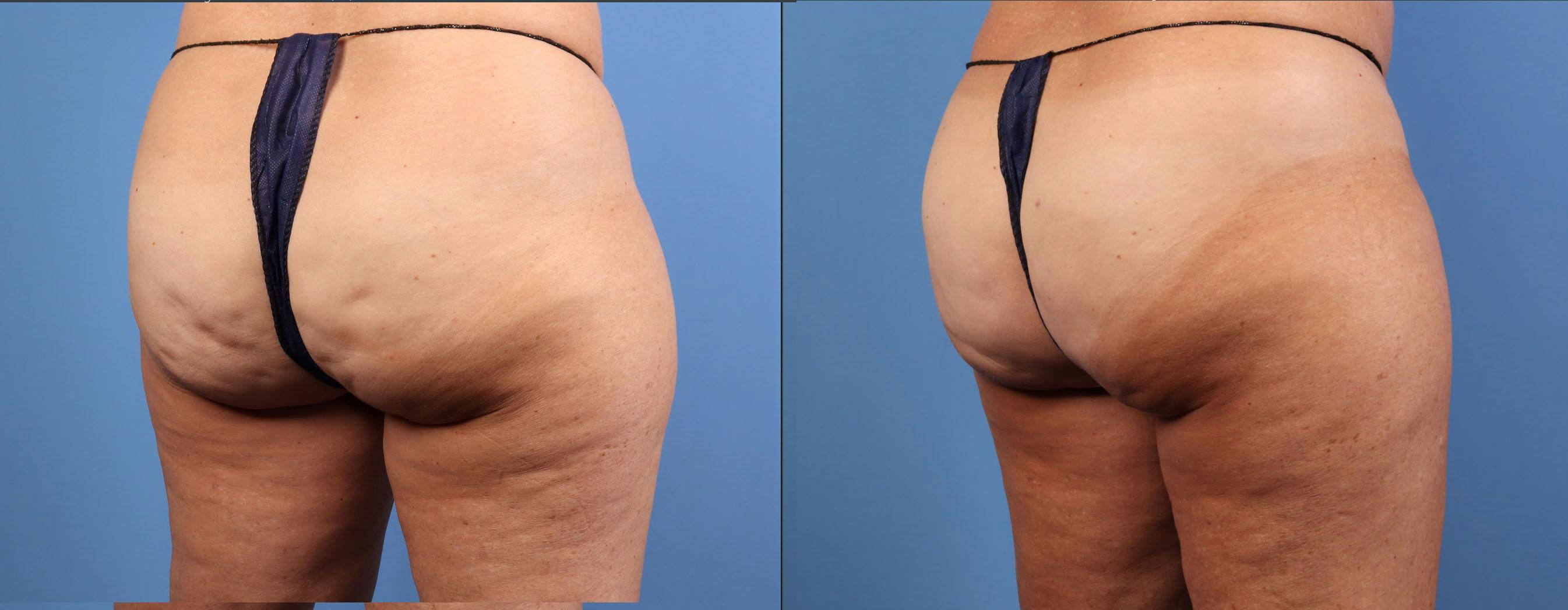 Aveli Before & After Gallery - Patient 150063 - Image 4