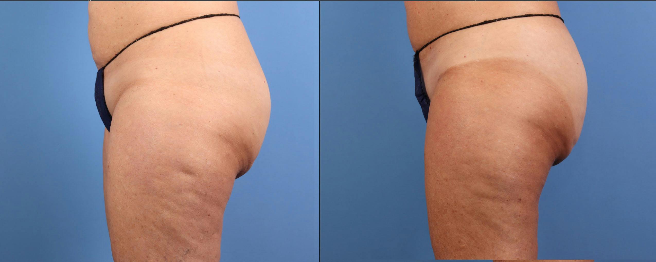 Aveli Before & After Gallery - Patient 150063 - Image 3