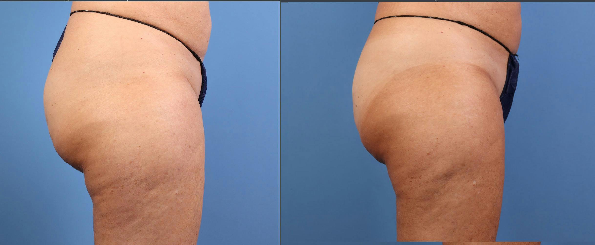 Aveli Before & After Gallery - Patient 150063 - Image 5