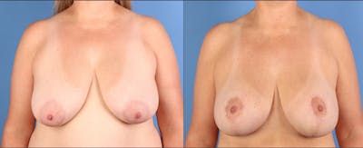 Breast Lift with Augmentation Before & After Gallery - Patient 371782 - Image 1
