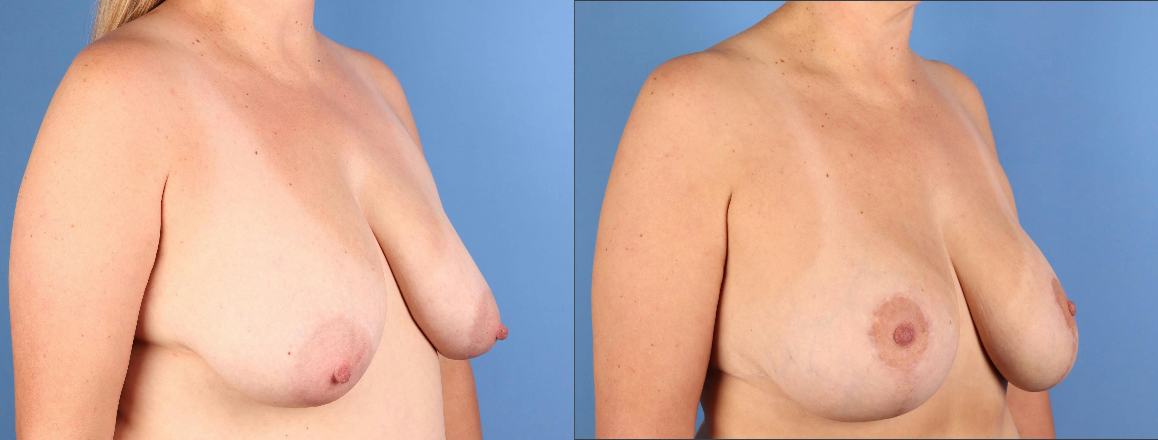 Mommy Makeover Before & After Gallery - Patient 130733 - Image 9