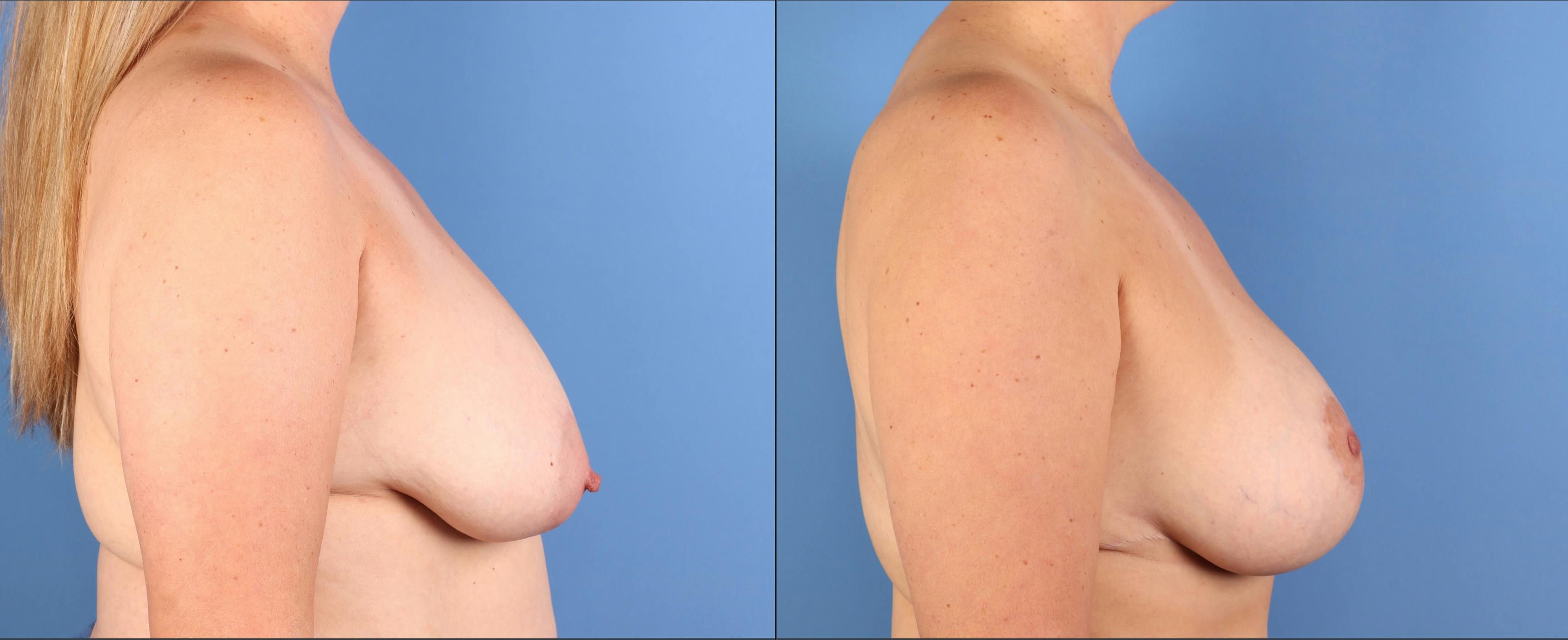 Mommy Makeover Before & After Gallery - Patient 130733 - Image 10