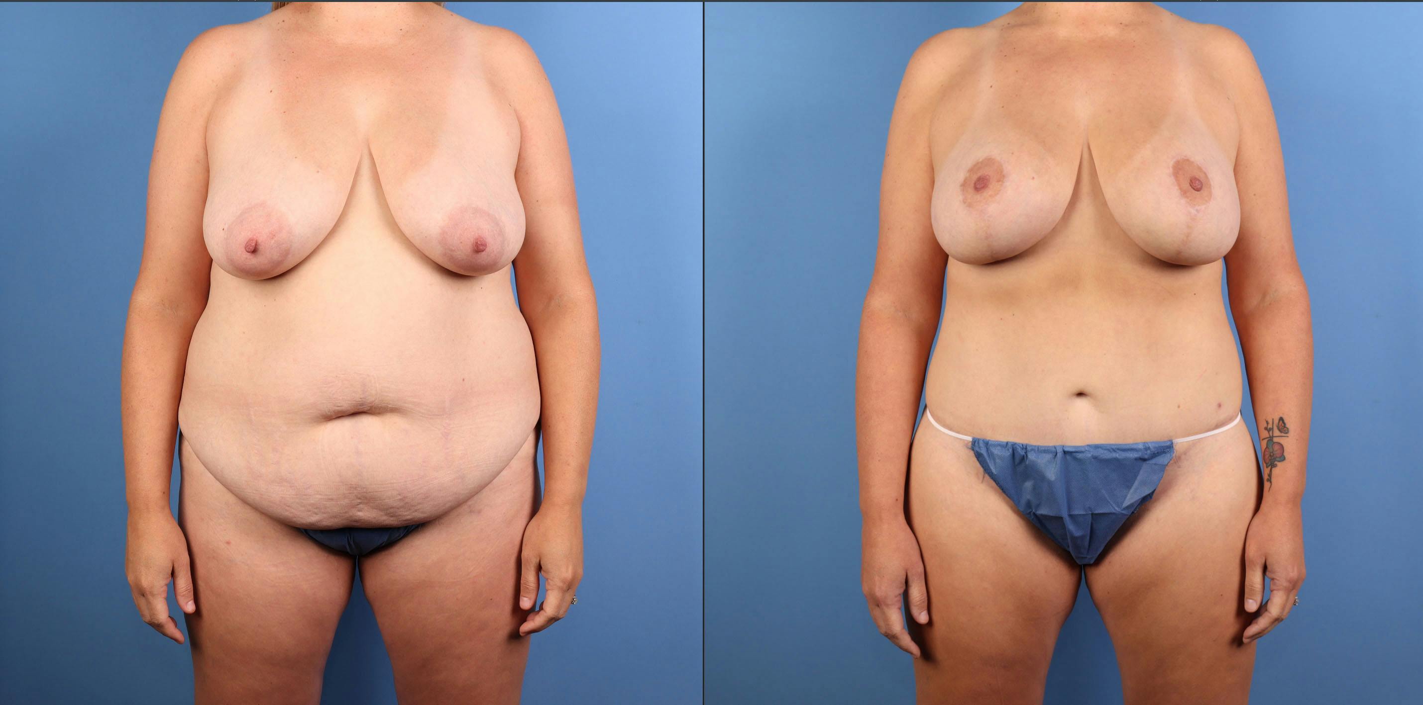 Mommy Makeover Before & After Gallery - Patient 130733 - Image 1