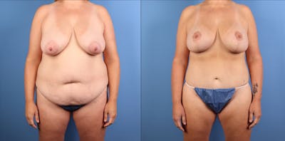 Mommy Makeover Before & After Gallery - Patient 130733 - Image 1