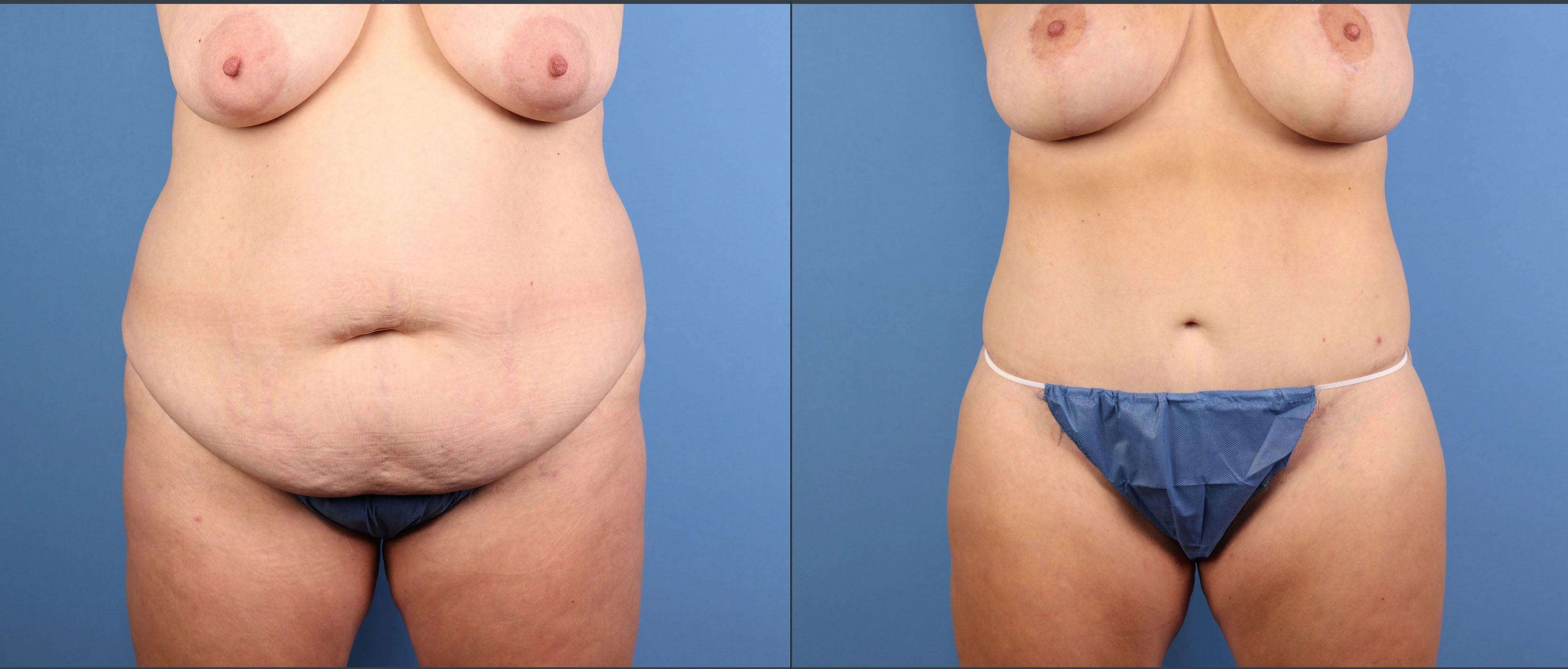 Mommy Makeover Before & After Gallery - Patient 130733 - Image 2