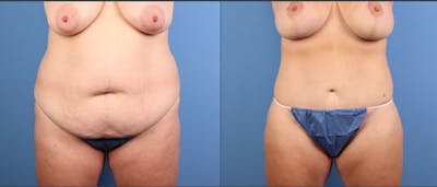Tummy Tuck Before & After Gallery - Patient 410922 - Image 1