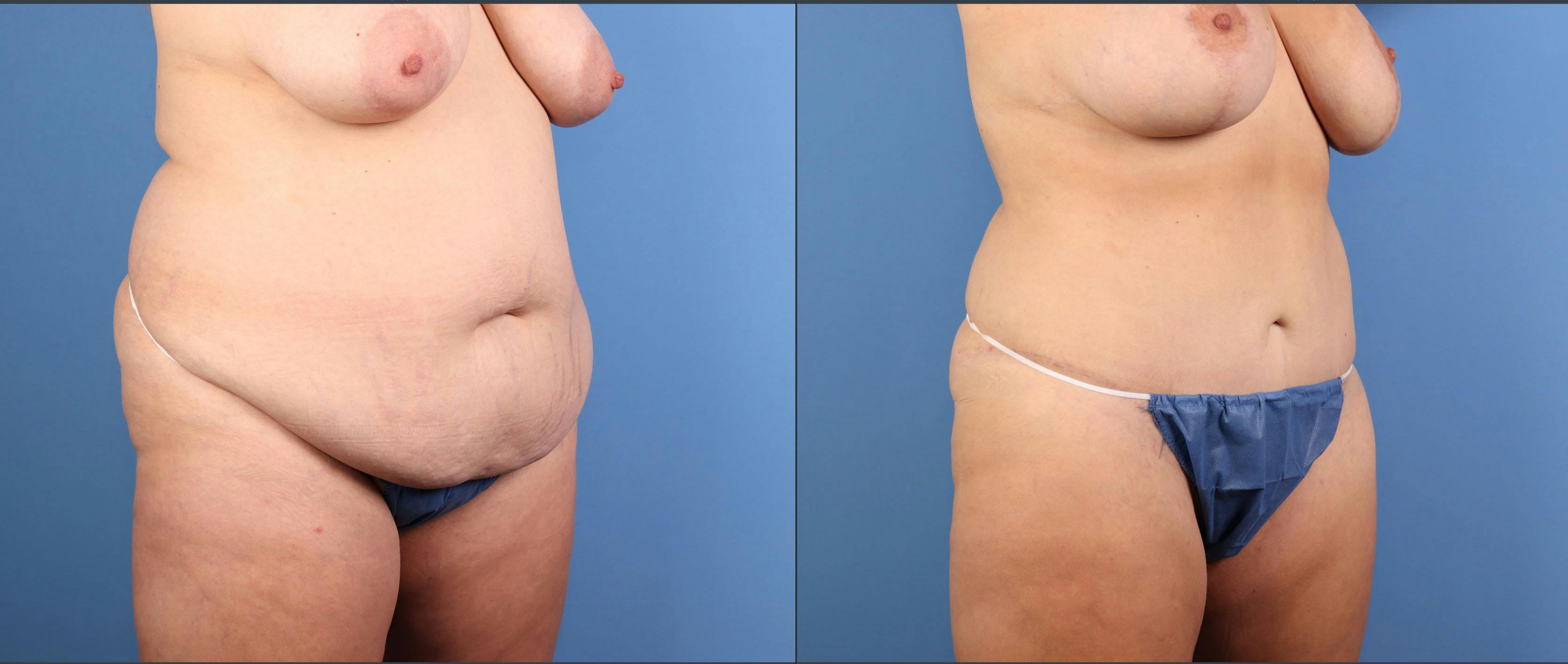 Mommy Makeover Before & After Gallery - Patient 130733 - Image 4