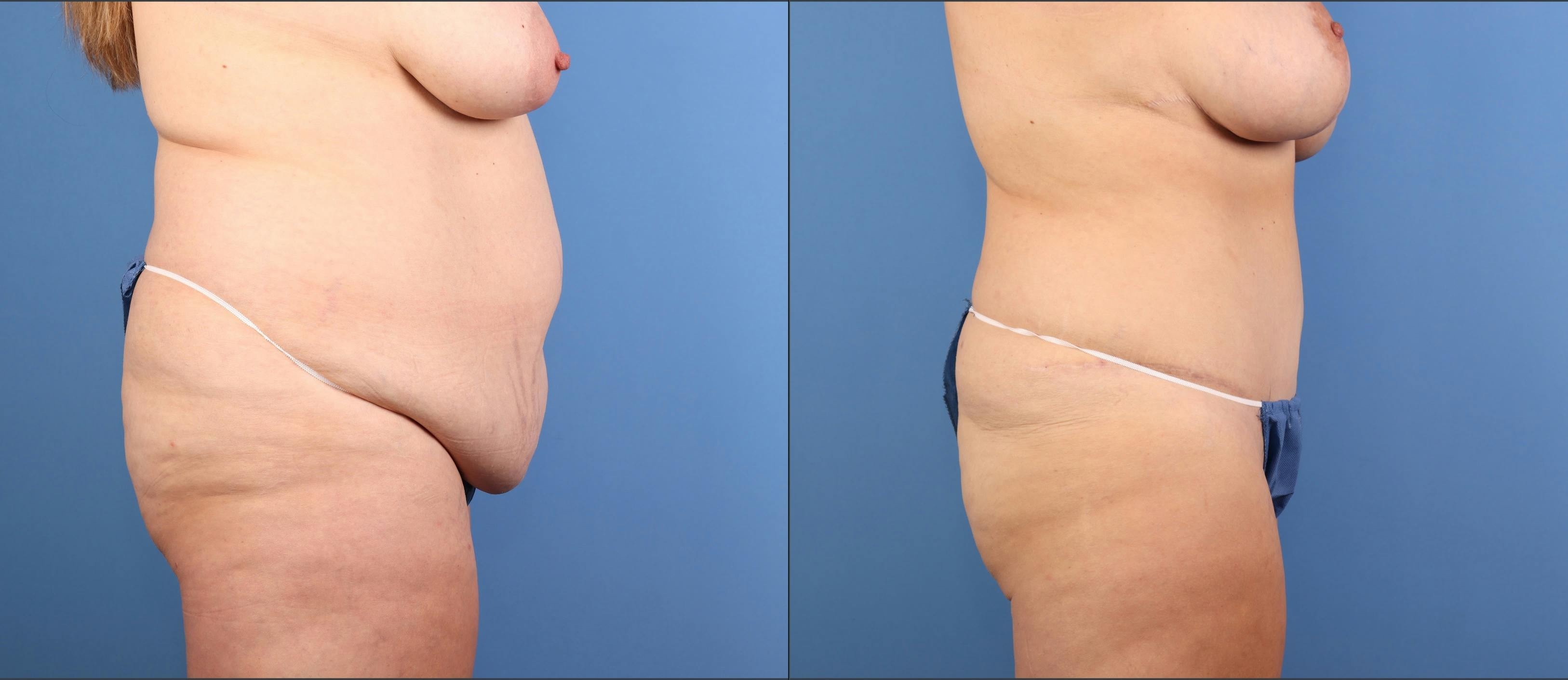 Mommy Makeover Before & After Gallery - Patient 130733 - Image 5