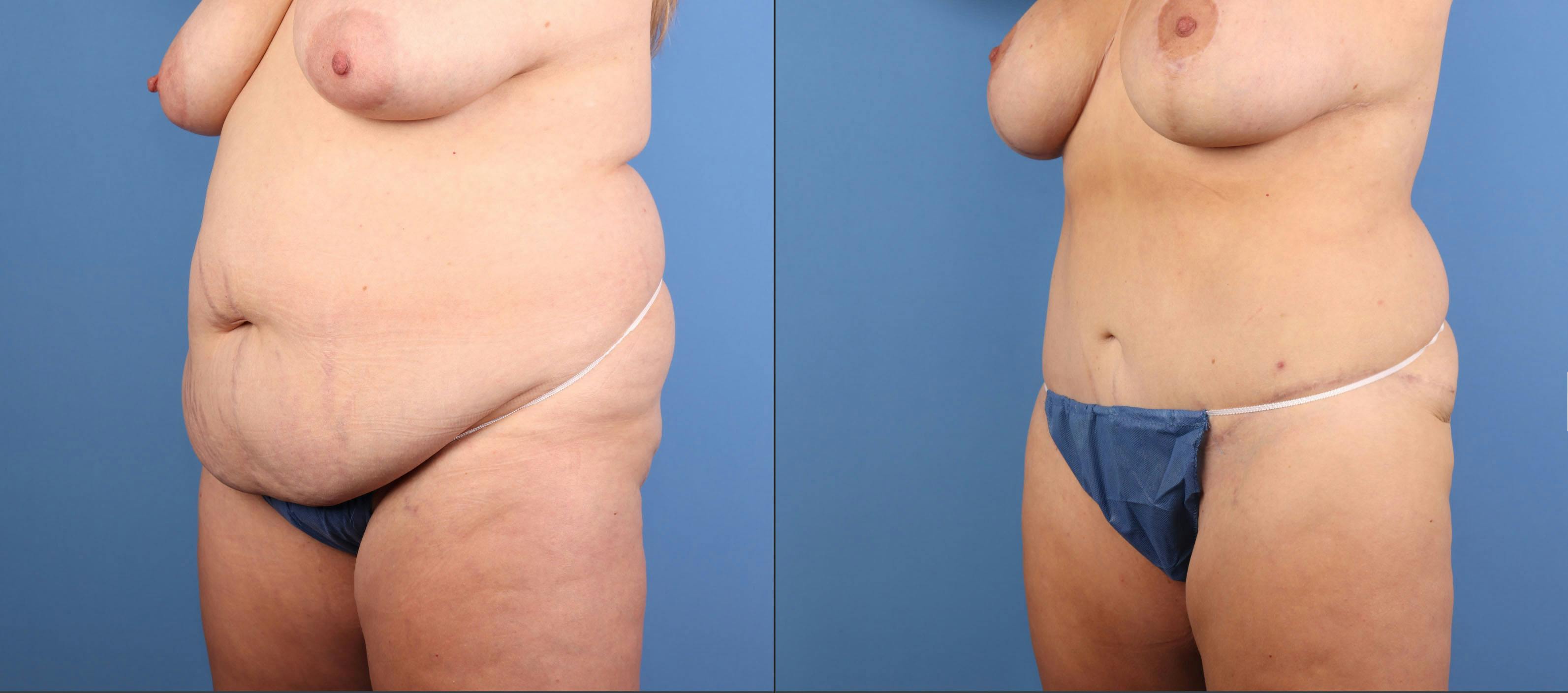 Mommy Makeover Before & After Gallery - Patient 130733 - Image 3