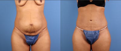Tummy Tuck Before & After Gallery - Patient 342151 - Image 1