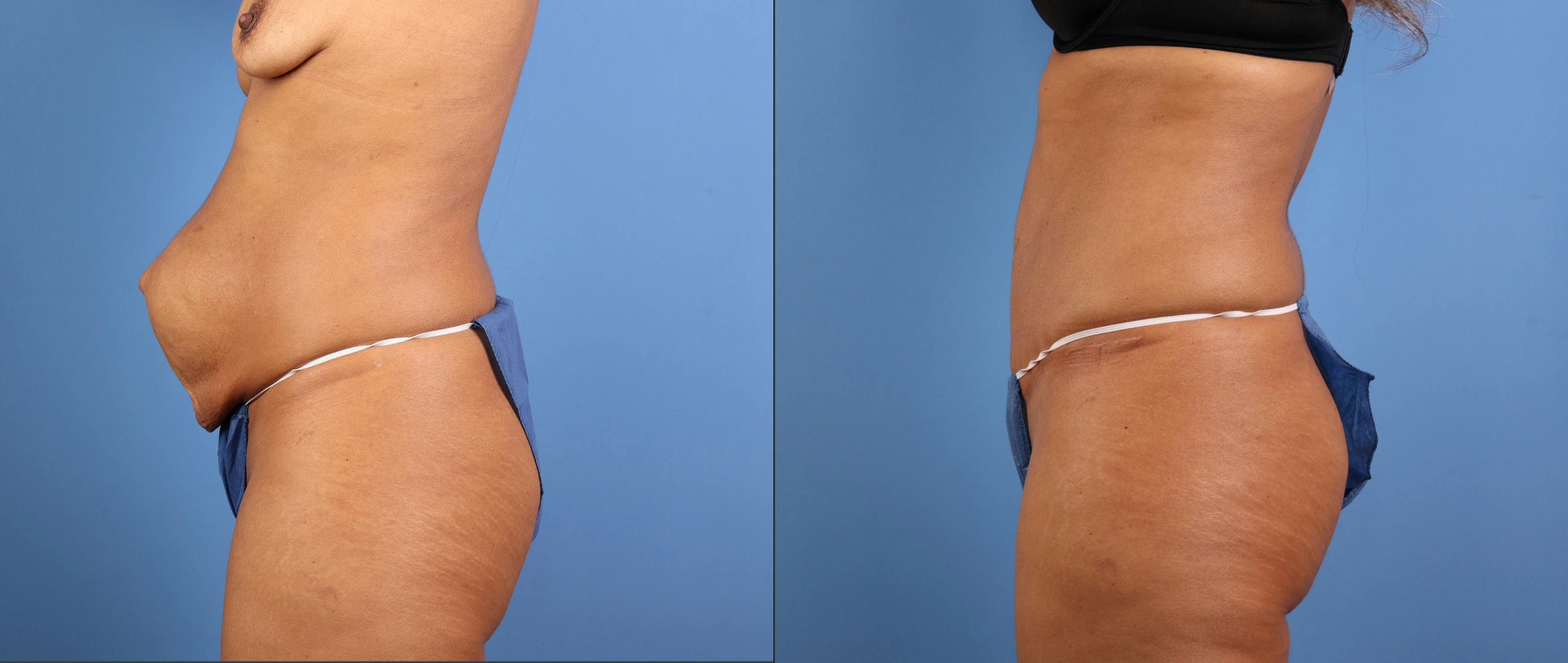 Tummy Tuck Before & After Gallery - Patient 342151 - Image 5