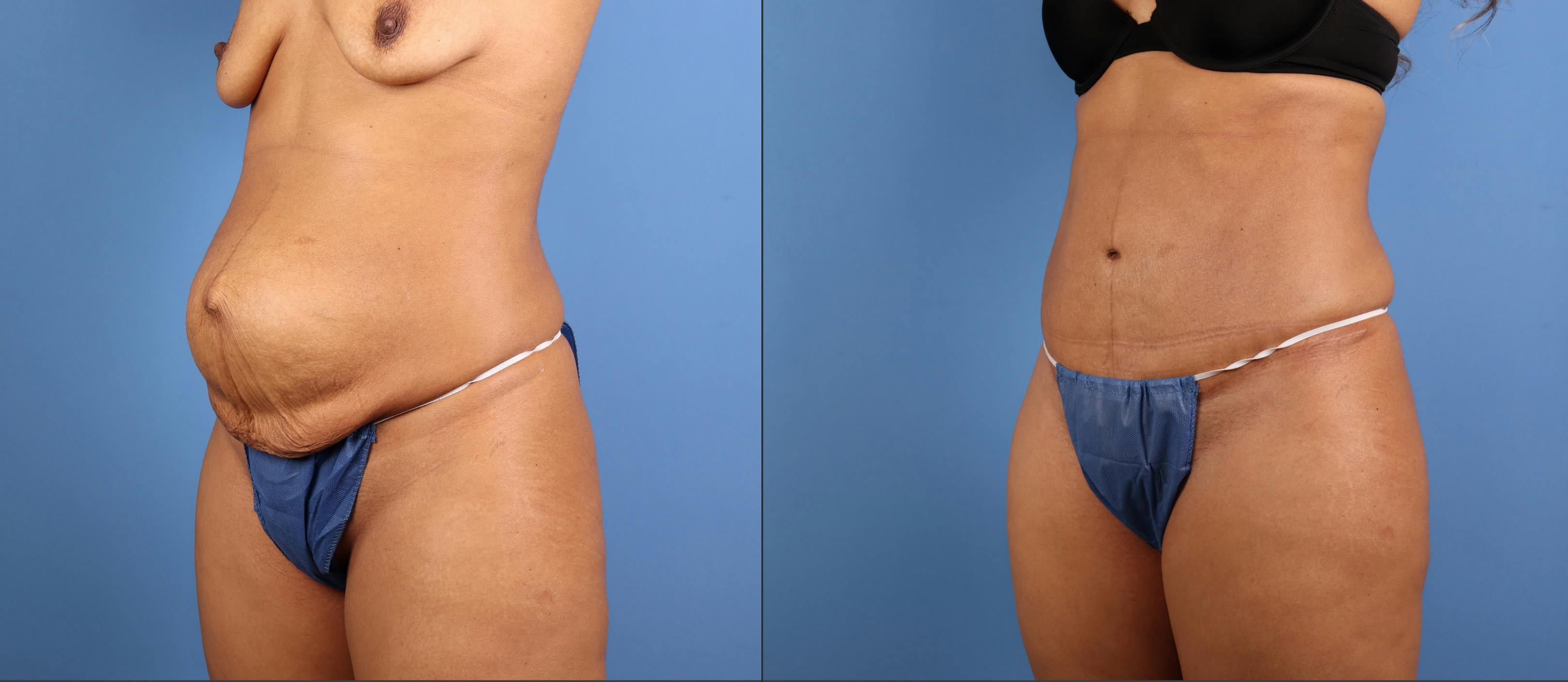 Tummy Tuck Before & After Gallery - Patient 342151 - Image 4
