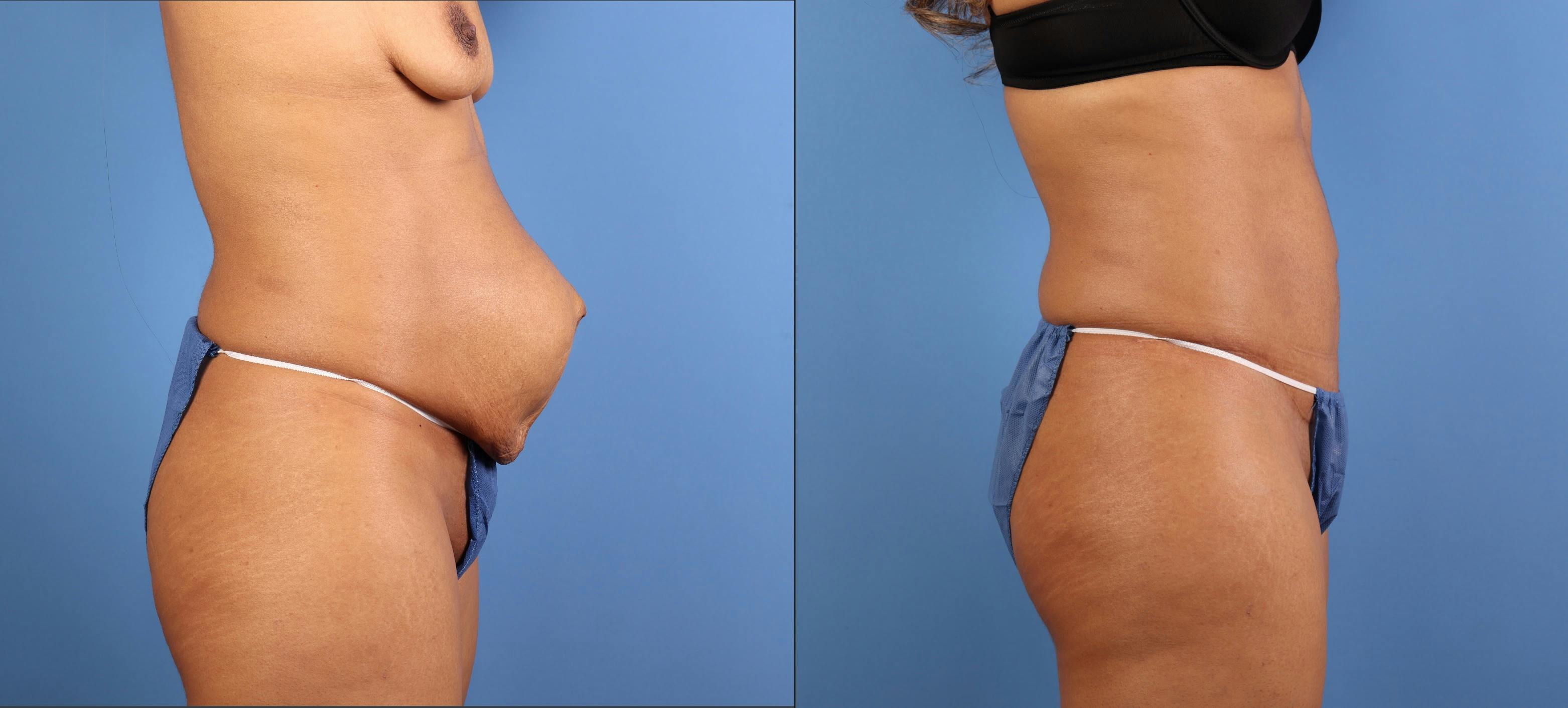 Tummy Tuck Before & After Gallery - Patient 342151 - Image 3