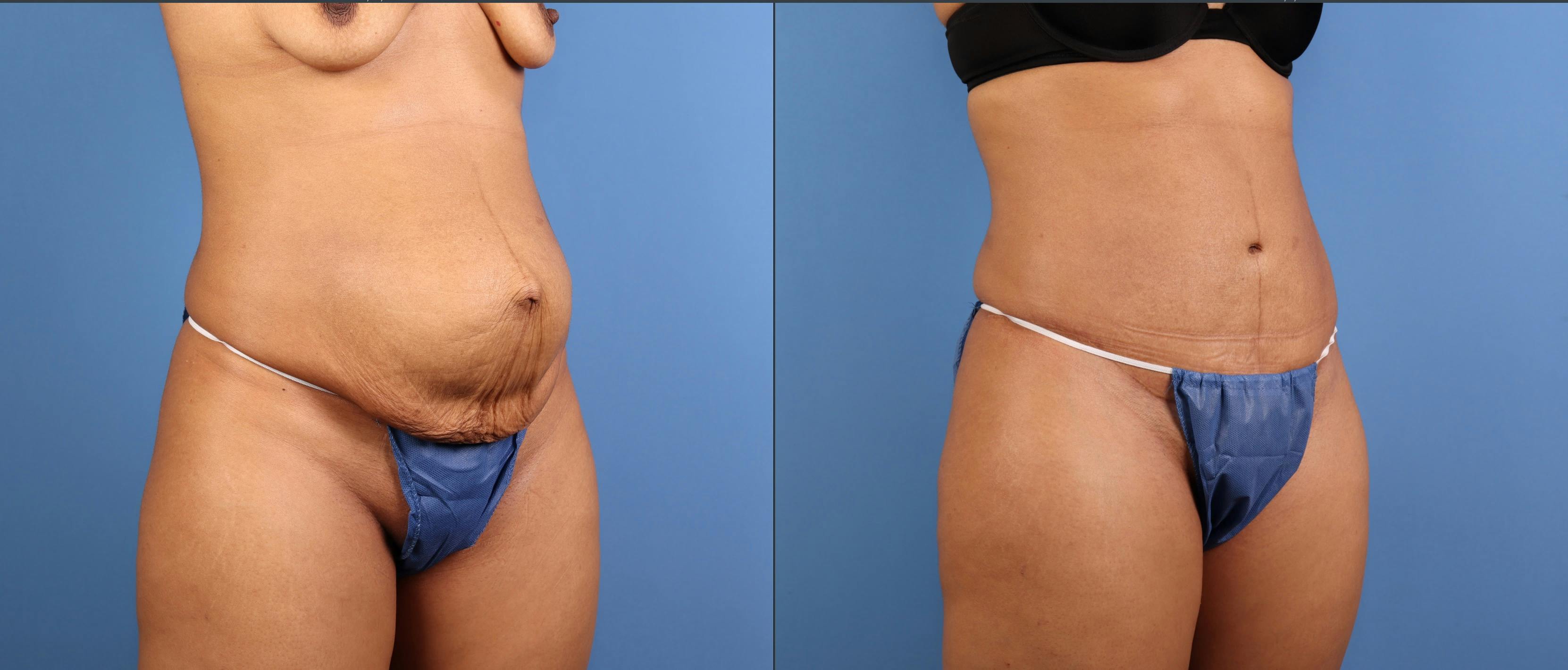 Tummy Tuck Before & After Gallery - Patient 342151 - Image 2