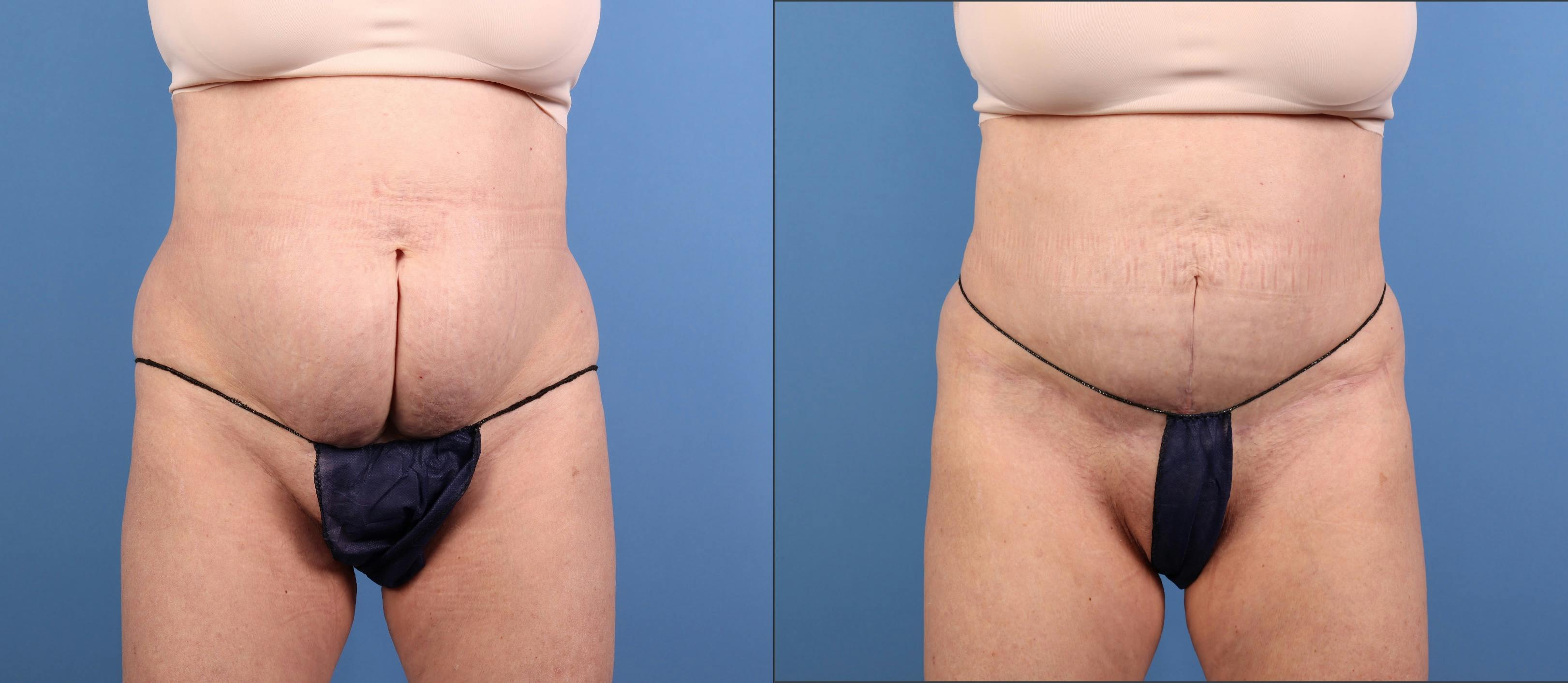 Abdomen Before & After Gallery - Patient 416847 - Image 1