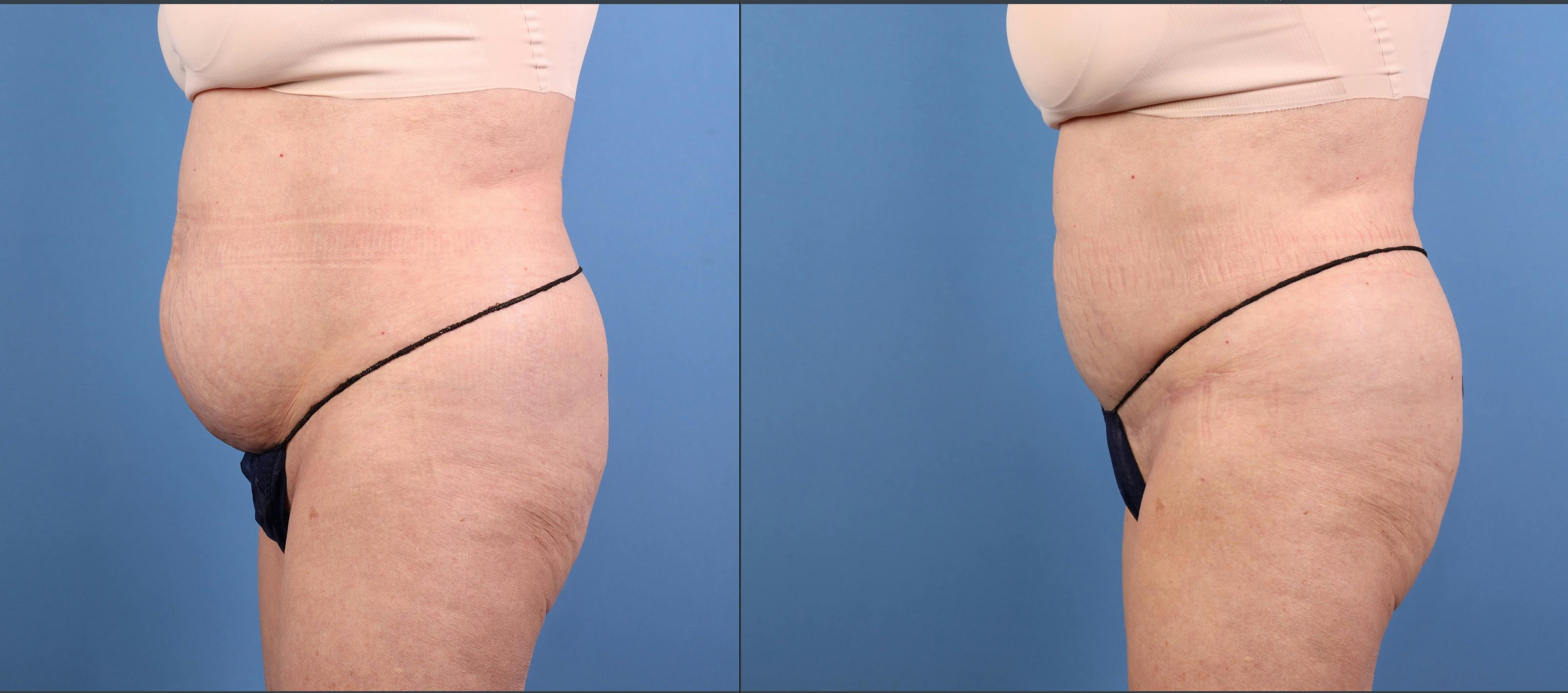 Abdomen Before & After Gallery - Patient 416847 - Image 3