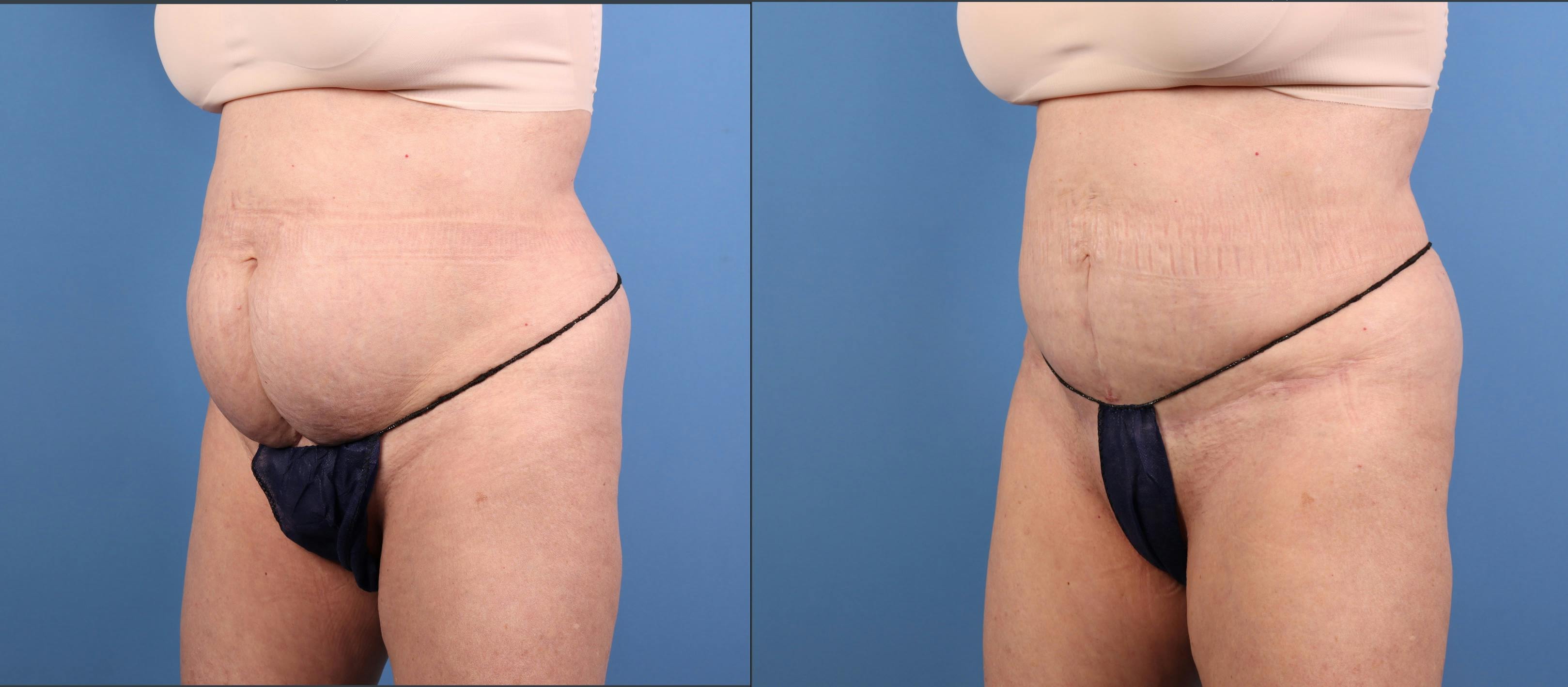 Abdomen Before & After Gallery - Patient 416847 - Image 2