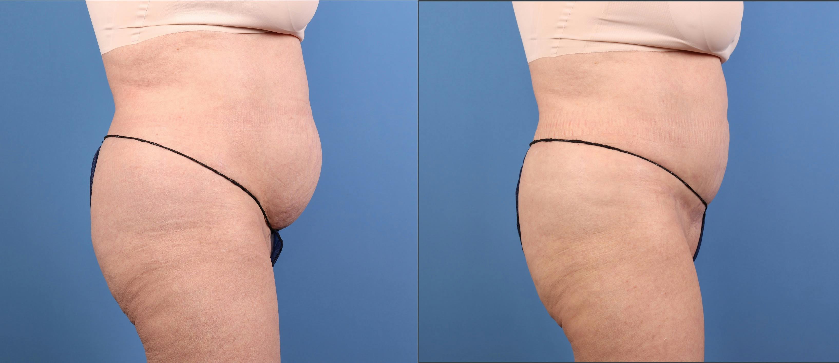 Abdomen Before & After Gallery - Patient 416847 - Image 5
