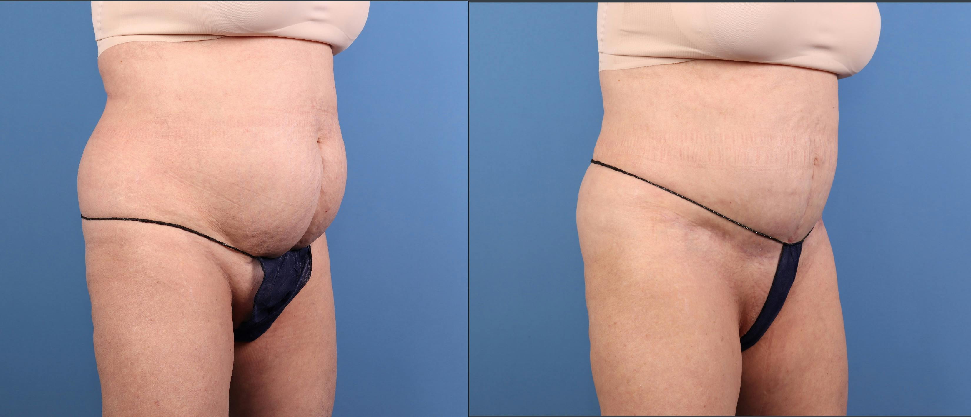 Abdomen Before & After Gallery - Patient 416847 - Image 4