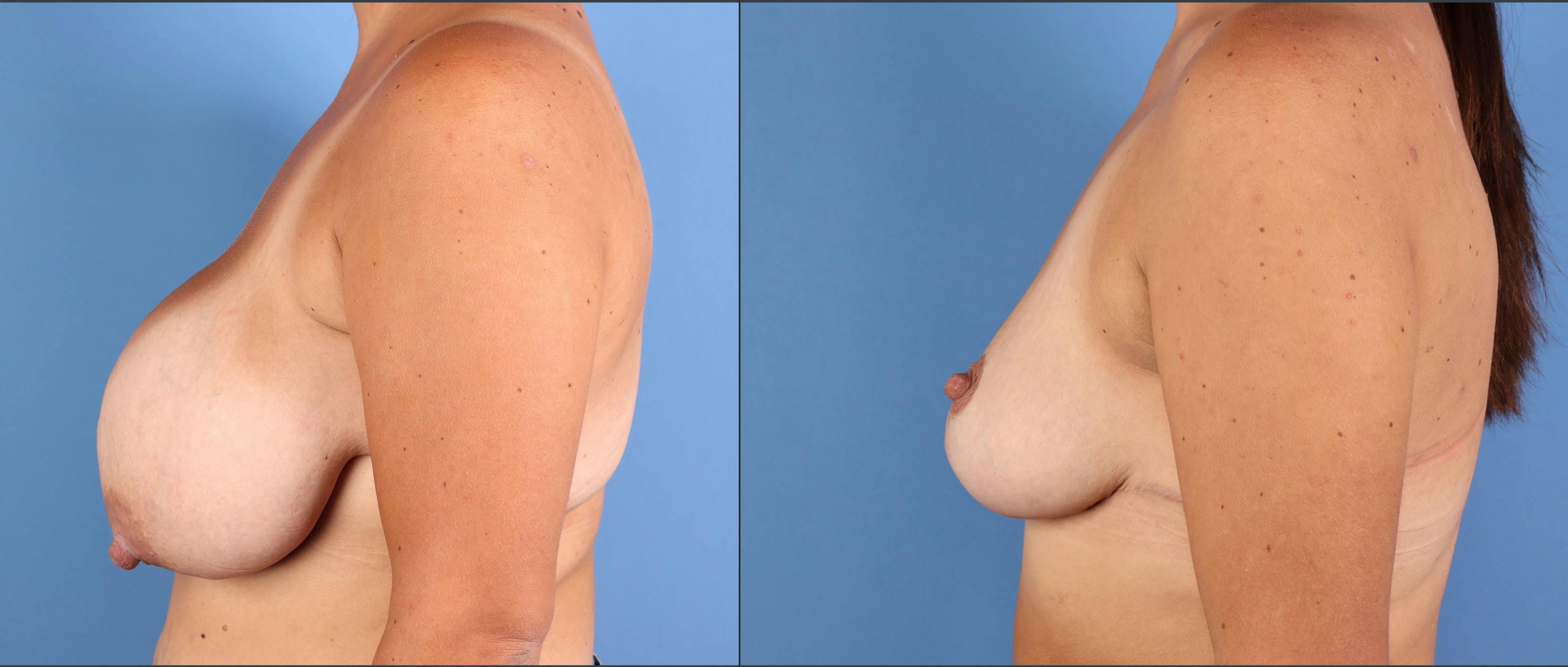 Breast Reduction Before & After Gallery - Patient 227851 - Image 3