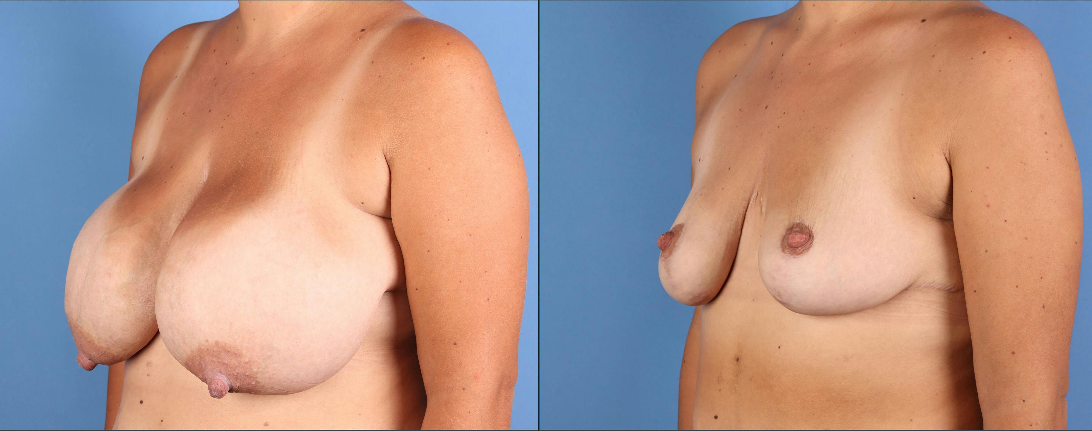 Breast Reduction Before & After Gallery - Patient 227851 - Image 2