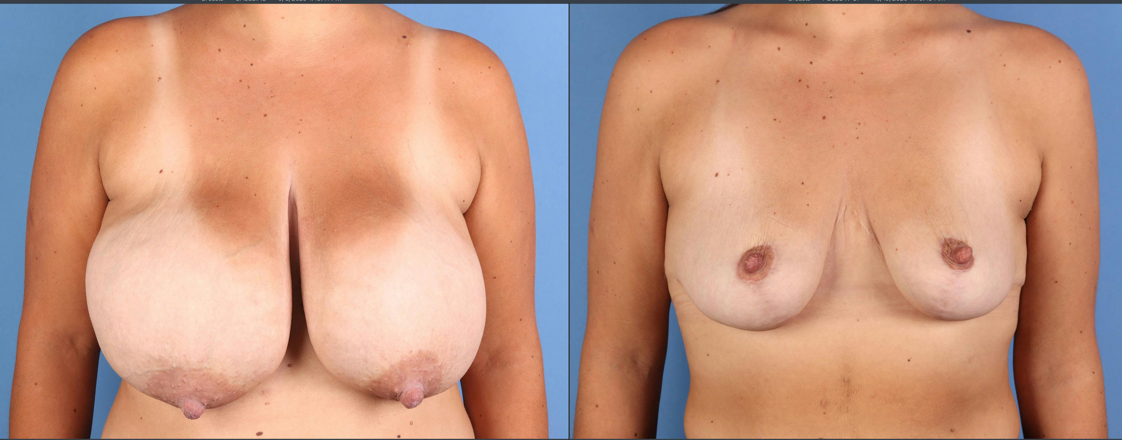 Breast Reduction Before & After Gallery - Patient 227851 - Image 1