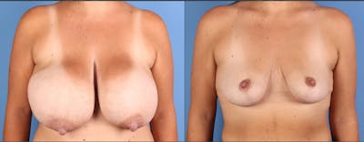 Breast Reduction Before & After Gallery - Patient 227851 - Image 1