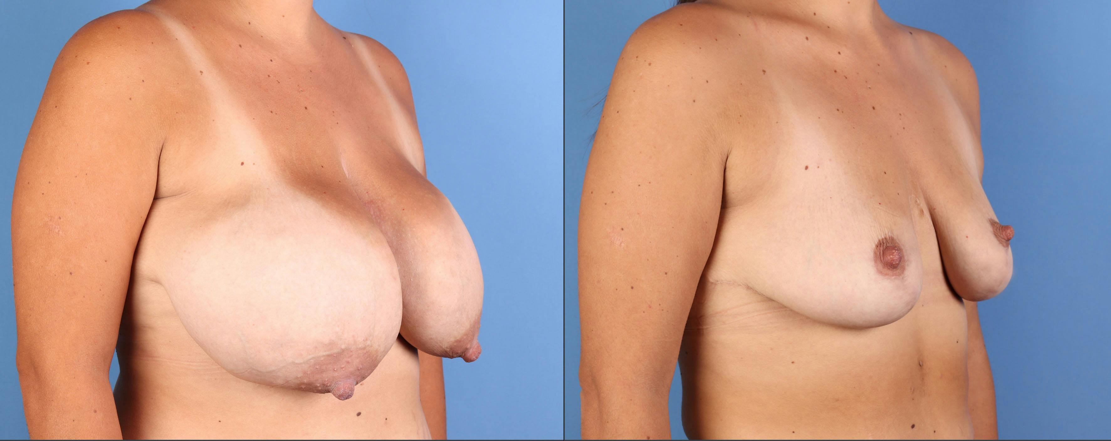 Breast Reduction Before & After Gallery - Patient 227851 - Image 4