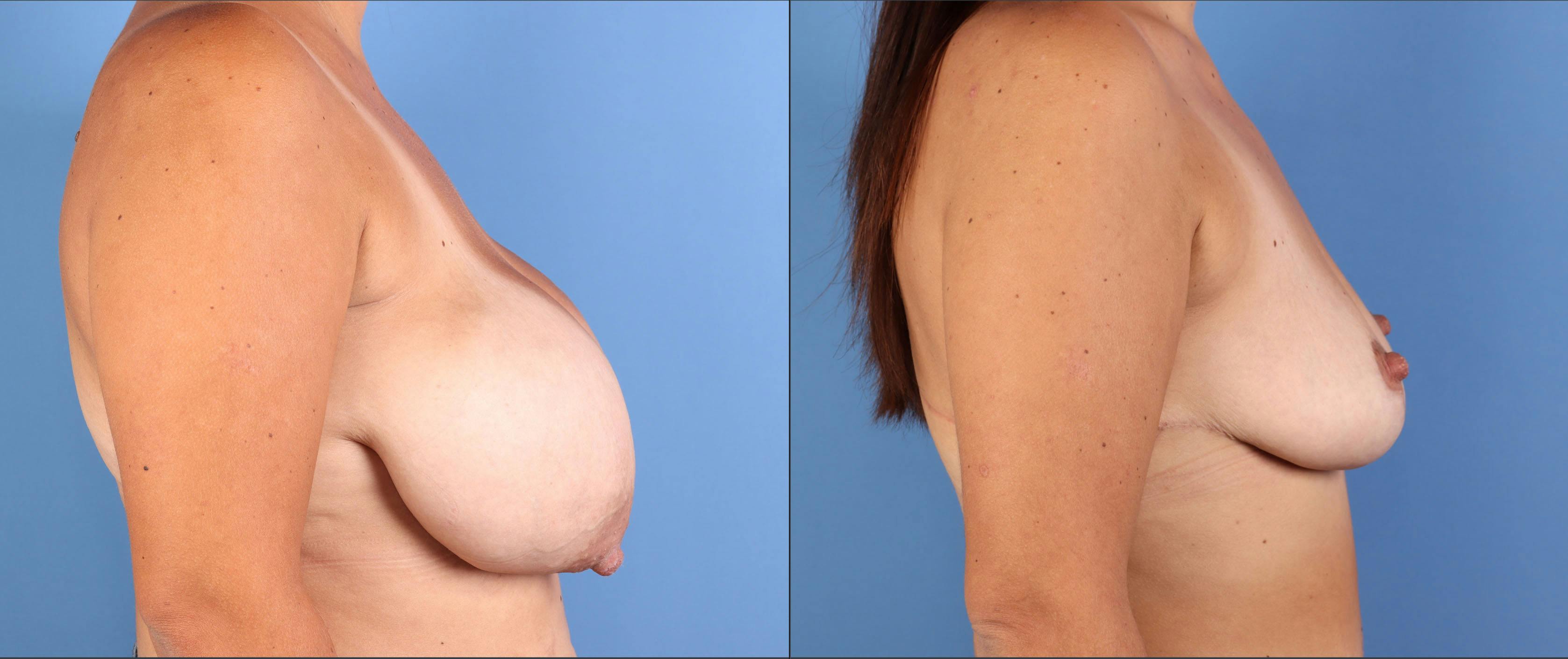 Breast Reduction Before & After Gallery - Patient 227851 - Image 5