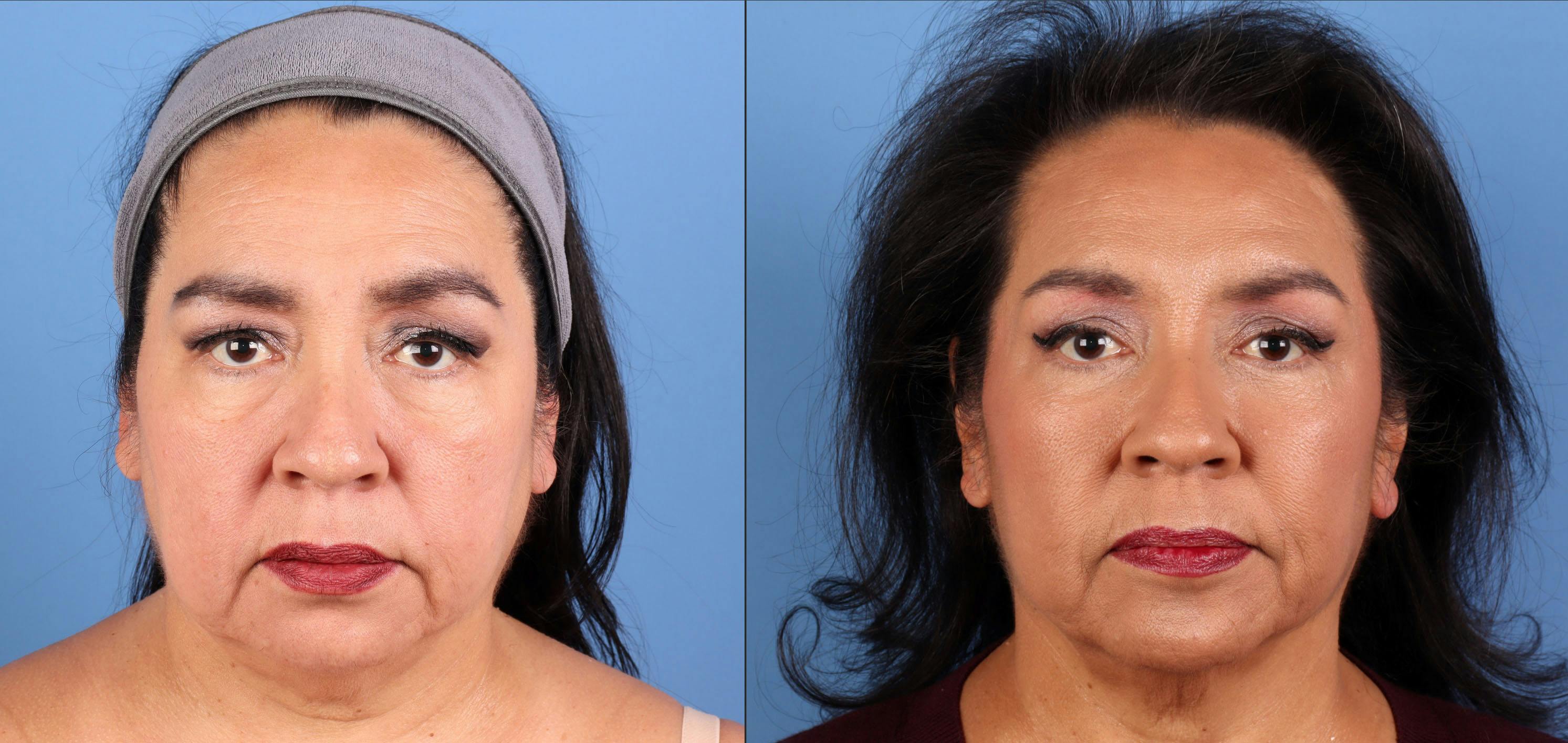 Eyelid Surgery (Upper & Lower Blepharoplasty) Before & After Gallery - Patient 915372 - Image 1