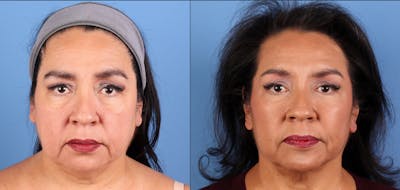 Eyelid Surgery (Upper & Lower Blepharoplasty) Before & After Gallery - Patient 915372 - Image 1